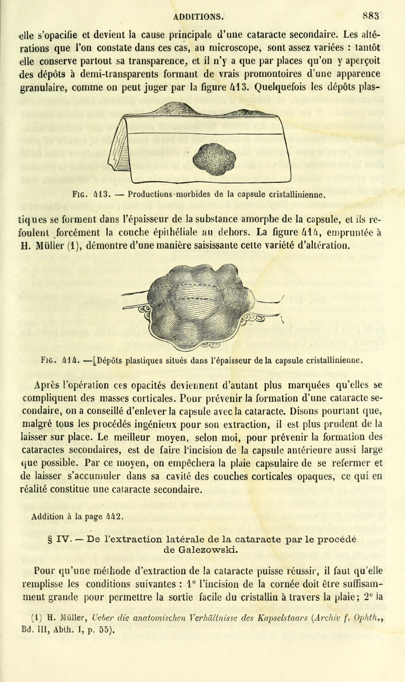 «lie s'opacifie et devient la cause principale d'une cataracte secondaire. Les alté- rations que l'on constate dans ces cas, au microscope, sont assez variées : tantôt elle conserve partout sa transparence^ et il n'y a que par places qu'on y aperçoit des dépôts à demi-transparents formant de vrais promontoires d'une apparence granulaire, comme on peut juger par la figure /il 3. Quelquefois les dépôts plas- FiG. 413. — Productions morbides de la capsule cristallinienne. tiques se forment dans l'épaisseur de la substance amorphe de la capsule, et ils re- foulent forcément la couche épiihéliale au dehors. La figure /il ù, empruntée à H. Millier (1), démontre d'une manière saisissante cette variété d'altération. Fjg. àiU. —[Dépôts plastiques situés dans l'épaisseur delà capsule cristallinienne. Après l'opération ces opacités deviennent d'autant plus marquées qu'elles se compliquent des masses corticales. Pour prévenir la formation d'une cataracte se- condaire, on a conseillé d'enlever la capsule avec la cataracte. Disons pourtant que, malgré tous les procédés ingénieux pour son extraction, il est plus prudent de la laisser sur place. Le meilleur moyen, selon moi, pour prévenir la formation des cataractes secondaires, est de faire l'incision de la capsule antérieure ausîii large que possible. Par ce moyen, on empêchera la plaie capsulaire de se refermer et de laisser s'accumuler dans sa cavité des couches corticales opaques, ce qui en réalité constitue une cataracte secondaire. Addition à la page lili2. § IV. ~ De l'extraction latérale de la cataracte par le procédé de Galezowski. Pour qu'une méihode d'extraction de la cataracte puisse réussir, il faut qu'elle remplisse les conditions suivantes : l'' l'incision de la cornée doit être suffisam- ment grande pour permettre la sortie facile du cristallin à travers la plaie; 2° la (1) H. Millier, Ueber die anatomischen Verhdltnisse des Kapselstaars {Archiv f. Ophth.f Bd. III, Abth. I, p. 55).