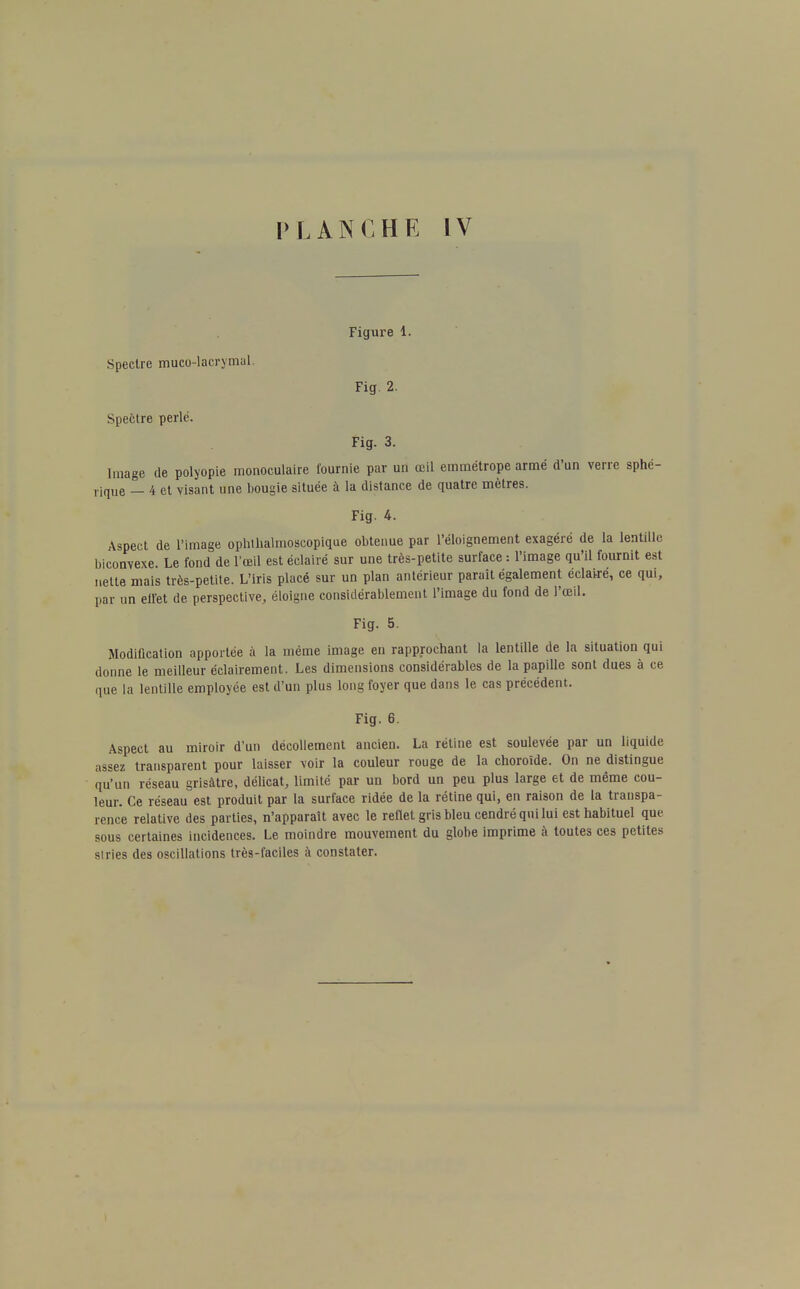 Figure 1. Spectre muco-lacrymal. Fig. 2. Spectre perlé. Fig. 3. Image de polyopie monoculaire fournie par un œil emmétrope armé d'un verre sphé- rique _ 4 et visant une bougie située à la distance de quatre mètres. Fig. 4. Aspect de l'image ophtlialmoscoplque obtenue par l'éloignement exagéré de la lentille biconvexe. Le fond de l'œil est éclairé sur une très-petite surface : l'image qu'il fournit est nette mais très-petite. L'iris placé sur un plan antérieur paraît également éclairé, ce qui, par un effet de perspective, éloigne considérablement l'image du fond de l'œil. Fig. 5. Modification apportée à la même image en rapprochant la lentille de la situation qui donne le meilleur éclairement. Les dimensions considérables de la papille sont dues à ce que la lentille employée est d'un plus long foyer que dans le cas précédent. Fig. 6. Aspect au miroir d'un décollement ancien. La rétine est soulevée par un liquide assez transparent pour laisser voir la couleur rouge de la choroïde. On ne distingue qu'un réseau grisâtre, délicat, limité par un bord un peu plus large et de même cou- leur. Ce réseau est produit par la surface ridée de la rétine qui, en raison de la transpa- rence relative des parties, n'apparaît avec le reflet gris bleu cendré qui lui est habituel que sous certaines incidences. Le moindre mouvement du globe imprime à toutes ces petites su ies des oscillations très-faciles à constater.