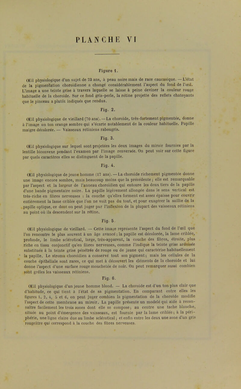 Figure 1. OEil physiologique d'un sujet de 23 ans, à peau noire mais de race caucasique. — L'état de la pigmentation choroïdienne a changé considérahlement l'aspect du fond de l'œil. L'image a une teinte grise à travers laquelle se laisse à peine deviner la couleur rouge habituelle de la choroïde. Sur ce fond gris-perle, la rétine projette des reflets chatoyants que le pinceau a plutôt indiqués que rendus. Fig. 2. OEil physiologique de vieillard (70 ans). —La choroïde, très-fortement pigmentée, donne à l'image un ton orange sombre qui s'écarte notablement de la couleur habituelle. Papille maigre décolorée. — Vaisseaux rétiniens rabougris. Fig. 3. OEil physiologique sur lequel sont projetées les deux images du miroir fournies par la lentille biconvexe pendant l'examen par l'image renversée. On peut voir sur cette figure par quels caractères elles se distinguent de la papille. Fig. 4. OEil physiologique de jeune homme (17 ans).— La choroïde richement pigmentée donne une image encore sombre, mais beaucoup moins que la précédente ; elle est remarquable par l'aspect et la largeur de l'anneau choroïdien qui entoure les deux tiers de la papille d'une bande pigmentaire noire. La papille légèrement allongée dans le sens vertical est très-riche en fibres nerveuses : la couche qu'elles forment est assez épaisse pour couvrir entièrement la lame criblée que l'on ne voit pas du tout, et pour exagérer la saillie de la papille optique, ce dont on peut juger par l'inflexion de la plupart des vaisseaux rétiniens au point où ils descendent sur la rétine. Fig. 5. OEil physiologique de vieillard. — Cette image représente l'aspect du fond de l'œil que l'on rencontre le plus souvent à un âge avancé ; la papille est décolorée, la lame criblée, profonde, le limbe sclérotical, large, très-apparent, la couche des fibres, étroite, plus riche en tissu conjonctif qu'en fibres nerveuses, comme l'indique la teinte grise ardoisée substituée à la teinte grise pénétrée de rouge ou de jaune qui caractérise habituellement la papille. Le stroma choroïdien a conservé tout son pigment; mais les cellules de la couche épithéliale sont rares, ce qui met à découvert les éléments de la choroïde et lui donne l'aspect d'une surface rouge mouchetée de noir. On peut remarquer aussi combien sont grêles les vaisseaux rétiniens. Fig. 6. OEil physiologique d'un jeune homme blond. — La choroïde est d'un ton plus clair que d'habitude, ce qui lient à l'état de sa pigmentation. En comparant entre elles les figures 1, 2, 4, 5 et 6, on peut juger combien la pigmentation de la choroïde modifie l'aspect de cette membrane au miroir. La papille présente un modelé qui aide à recon- naître facilement les trois zones dont elle se compose; au centre une tache blanche, située au point d'émergence des vaisseaux, est fournie par la lame criblée; à la péri- phérie, une ligne claire due au limbe sclérotical ; et enfin entre les deux une zone d'un gris rougeàtre qui correspond à la couche des fibres nerveuses.