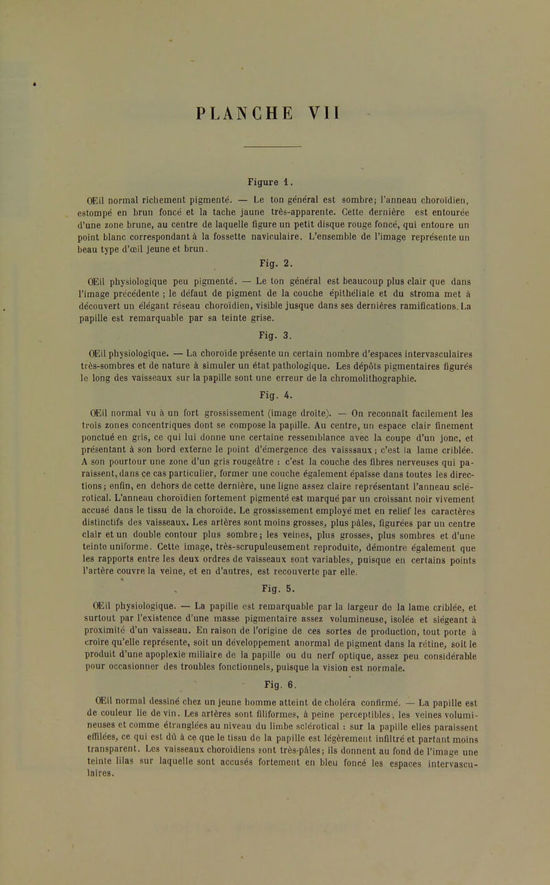 Figure 1. OEil normal richement pigmenté. — Le ton général est sombre; l'anneau choroïdien, estompé en brun foncé et la tache jaune trèà-apparente. Cette dernière est entourée d'une zone brune, au centre de laquelle figure un petit disque rouge foncé, qui entoure un point blanc correspondant à la fossette naviculaire. L'ensemble de l'image représente un beau type d'œil jeune et brun. Fig. 2. Œil physiologique peu pigmenté. — Le ton général est beaucoup plus clair que dans l'image précédente ; le défaut de pigment de la couche épithéliale et du stroma met à découvert un élégant réseau choroïdien, visible jusque dans ses dernières ramifications. La papille est remarquable par sa teinte grise. Fig. 3. Œil physiologique. — La choroïde présente un certain nombre d'espaces intervasculaires très-sombres et de nature à simuler un état pathologique. Les dépôts pigmentaires figurés le long des vaisseaux sur la papille sont une erreur de la chromolithographie. Fig. 4. Œil normal vu à un fort grossissement (image droite). — On reconnaît facilement les trois zones concentriques dont se compose la papille. Au centre, un espace clair finement ponctué en gris, ce qui lui donne une certaine ressemblance avec la coupe d'un jonc, et présentant à son bord externe le point d'émergence des vaisssaux ; c'est la lame criblée. A son pourtour une zone d'un gris rougeâtre : c'est la couche des fibres nerveuses qui pa- raissent, dans ce cas particulier, former une couche également épaisse dans toutes les direc- tions; enûn, en dehors de cette dernière, une ligne assez claire représentant l'anneau sclé- rotical. L'anneau choroïdien fortement pigmenté est marqué par un croissant noir vivement accusé dans le tissu de la choroïde. Le grossissement employé met en relief les caractères distinctifs des vaisseaux. Les artères sont moins grosses, plus pâles, figurées par un centre clair et un double contour plus sombre; les veines, plus grosses, plus sombres et d'une teinte uniforme. Cette image, très-scrupuleusement reproduite, démontre également que les rapports entre les deux ordres de vaisseaux sont variables, puisque en certains points l'artère couvre la veine, et en d'autres, est recouverte par elle. Fig. 5. Œil physiologique. — La papille est remarquable par la largeur de la lame criblée, et surtout par l'existence d'une masse pigmentaire assez volumineuse, isolée et siégeant à proximité d'un vaisseau. En raison de l'origine de ces sortes de production, tout porte à croire qu'elle représente, soit un développement anormal de pigment dans la rétine, soit le produit d'une apoplexie miliaire de la papille ou du nerf optique, assez peu considérable pour occasionner des troubles fonctionnels, puisque la vision est normale. Fig. 6. OEil normal dessiné chez un jeune bomme atteint de choléra confirmé. — La papille est de couleur lie de vin. Les artères sont filiformes, à peine perceptibles, les veines volumi- neuses et comme étranglées au niveau du limbe sclérolical : sur la papille elles paraissent effilées, ce qui est dû à ce que le tissu de la papille est légèrement infiltré et partant moins transparent. Les vaisseaux choroïdiens sont très-pâles; ils donnent au fond de l'image une teinte lilas sur laquelle sont accusés fortement en bleu foncé les espaces intervascu- laires.