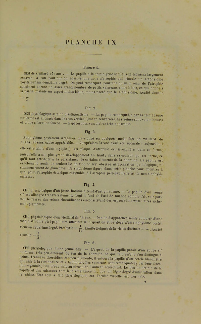 Figure 1. OEil de vieillard (6'i ans). — La papille a la teinte grise sénile; elle est assez largement excavée. A son pourtour on observe une zone d'atrophie qui simule un staphylôme postérieur au deuxième degré. On peut remarquer pourtant qu'au niveau de l'atrophie subsistent encore un assez grand nombre de petits vaisseaux choroïdiens, ce qui donne à la partie malade un aspect moins blanc, moins nacré que le staphylôme. Acuïlé visuelle Fig. 2. OEil physiologique atteint d'astigmatisme. — La papille remarquable par sa teinte jaune uniforme est allongée dans le sens vertical (image renversée). Les veines sont volumineuses et d'une coloration foncée. — Espaces intervasculaires très-apparents. Fig. 3. Staphylôme postérieur irrégulier, développé en quelques mois chez un vieillard de 71 ans, et sans cause appréciable. — Jusqu'alors la vue avait été normale : aujourd'hui elle est atteinte d'une myopie A-. La plaque d'atrophie est irrégulière dans sa forme, puisqu'elle a son plus grand développement en haut; dans sa couleur qui est terne, ce qu'il faut attribuer à la persistance de certains éléments de la choroïde. La papille est exactement ronde, de couleur lie de vin; on n'y observe ni excavation pathologique, ni commencement de glaucome. Ce staphylôme figure dans cette planche pour montrer à quel point l'atrophie éctasique ressemble à l'atrophie péri-papiliaire sénile non staphylô- mateuse. Fig. 4. OEil physiologique d'un jeune homme atteint d'astigmatisme. — La papille d'un rouge vif est allongée transversalement. Tout le fond de l'œil de nuance sombre fait voir par- tout le réseau des veines choioïdiennes circonscrivant des espaces intervasculaires riche- ment pigmentés. Fig. 5. OEil physiologique d'un vieillard de 74 ans. — Papille d'apparence sénile entourée d'une zone d'atrophie péri-papilliaire affectant la disposition et le siège d'un staphylôme posté- rieur au deuxième degré. Presbytie = I. Limite éloignée de la vision distincte = «. Acuité visuelle = 2 Fig. 6. OEil physiologique d'une jeune fille. - L'aspect de la papille parait d'un rouge vir uniforme, très-peu différent du ton de la choroïde, ce qui fait qu'elle s'en distingue à peine. L'anneau choroïdien est-peu pigmenté, il entoure la papille d'un cercle blanchâtre qui aide à la reconnaître et à la limiter. Les vaisseaux sont remarquables par leur direc- tion rayonnée; l'un d'eux naît au niveau de l'anneau sclérolical. Le peu de netteté de la papille et des vaisseaux vers leur émergence indique un léger degré d'infiltration dans la rétine. État tout à fait physiologique, car l'acuité visuelle est normale. 2