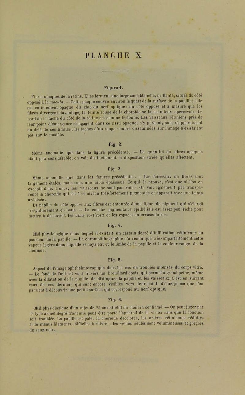 Figure 1. Kibrcs opaques de la rétine. Elles forment une large zone blanche, brillante, située du côté opposé à la macula. — Cette plaque couvre environ le quart de la surface de la papille ; elle est entièrement opaque du côté du nerf optique : du côté opposé et à mesure que les fibres divergent davantage, la teinte rouge de la choroïde se laisse mieux apercevoir. Le bord de la tache du côté de la rétine est comme festonné. Les vaisseaux rétiniens près de leur point d'émergence s'engagent dans ce tissu opaque, s'y perdent, puis réapparaissent au delà de ses limites; les taches d'un rouge sombre disséminées sur l'image n'existaient pas sur le modèle. Fig. 2. Même anomalie que dans la figure précédente. — La quantité de fibres opaques étant peu considérable, on voit distinctement la disposition striée qu'elles affectent. Fig. 3. Même anomalie que dans les figures précédentes. — Les faisceaux de fibres sont largement étalés, mais sous une faible épaisseur. Ce qui le prouve, c'est que si l'on en excepte deux troncs, les vaisseaux ne sont pas voilés. On voit également par transpa- rence la choroïde qui est à ce niveau très-fortement pigmentée et apparaît avec une teinte ardoisée. La papille du côté opposé aux fibres est entourée d'une ligne de pigment qui s'élargit irrégulièrement en haut. — La couche pigmentaire épithéliale est assez peu riche pour mettre à découvert les venœ vorticosœ et les espaces intervasculaires. Fig. 4. OEil physiologique dans lequel il existait un certain degré d'infiltration rétinienne au pourtour de la papille. — La chromolithographie n'a rendu que tiès-imparfaitement cette vapeur légère dans laquelle se noyaient et le limbe de la papille et la couleur rouge de la choroïde. Fig. 5. Aspect de l'image ophthalmoscopique dans les cas de troubles intenses du corps vitré. — Le fond de l'œil est vu à travers un brouillard épais, qui permet à grand'peine, même avec la dilatation de la pupille, de distinguer la papille et les vaisseaux. C'est en suivant ceux de ces derniers qui sont encore visibles vers leur point d'émergence que l'on parvient à découvrir une petite surface qui correspond au nerf optique. Fig. 6. Œil physiologique d'un sujet de 25 ans atteint de choléra confirmé. — On peut juger par ce type à quel degré d'anémie peut être porté l'appareil de la visiou sans que la fonction soit troublée. La papille est pâle, la choroïde décolorée, les artères rétiniennes réduites à de menus filaments, difficiles à suivre : les veines seules sont volumineuses et gorgées de sang noir.