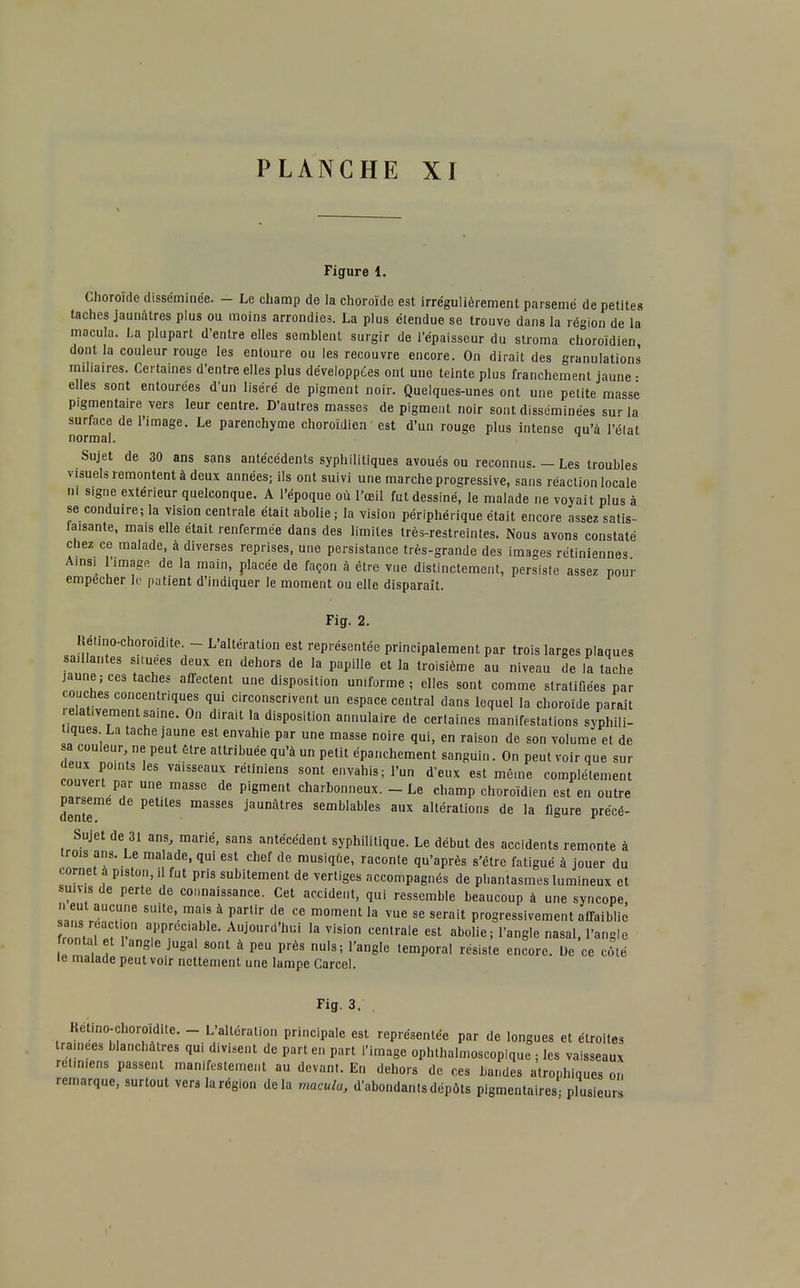 Figure 1. Choroïde disséminée. - Le champ de la choroïde est irrégulièrement parsemé de petites taches jaunâtres plus ou moins arrondies. La plus étendue se trouve dans la région de la macula. La plupart d'entre elles semblent surgir de l'épaisseur du stroma choroïdien dont la couleur rouge les entoure ou les recouvre encore. On dirait des granulations mihaires. Certaines d'entre elles plus développées ont une teinte plus franchement jaune • elles sont entourées d'un liséré de pigment noir. Quelques-unes ont une petite masse pigmentaire vers leur centre. D'autres masses de pigment noir sont disséminées sur la surface de l'image. Le parenchyme choroïdien est d'un rouge plus intense qu'à l'état normal. Sujet de 30 ans sans antécédents syphilitiques avoués ou reconnus. — Les troubles visuels remontent à deux années; ils ont suivi une marche progressive, sans réaction locale ni signe extérieur quelconque. A l'époque où l'œil fut dessiné, le malade ne voyait plus à se conduire; la vision centrale était abolie; la vision périphérique était encore assez satis- iaisante, mais elle était renfermée dans des limites très-restreintes. Nous avons constaté chez ce malade, à diverses reprises, une persistance très-grande des images rétiniennes Ainsi l'image de la main, placée de façon à être vue distinctement, persiste assez pour empêcher le patient d'indiquer le moment ou elle disparaît. Fig. 2. Rétino-choroïdite. - L'altération est représentée principalement par trois larges plaques saillantes situées deux en dehors de la papille et la troisième au niveau de la tache jaune; ces taches affectent une disposition uniforme; elles sont comme stratifiées par couches concentriques qui circonscrivent un espace central dans lequel la choroïde paraît relativement saine. On dirait la disposition annulaire de certaines manifestations syphili- tiques La tache jaune est envahie par une masse noire qui, en raison de son volume et de sa couleur ne peut être attribuée qu'à un petit épanchement sanguin. On peut voir que sur deux points les vaisseaux rétiniens sont envahis; l'un d'eux est même complètement couvert par une masse de pigment charbonneux. - Le champ choroïdien est en outre parsemé de petites masses jaunâtres semblables aux altérations de la figure précé- Sujet de 31 ans, marié, sans antécédent syphilitique. Le début des accidents remonte à trois ans. Le malade, qui est chef de musique, raconte qu'après s'être fatigué à jouer du cornet à piston, ,1 fut pris subitement de vertiges accompagnés de phantasmes lumineux et suivis de perte de connaissance. Cet accident, qui ressemble beaucoup à une syncope, n eut aucune suite, mais à partir de ce moment la vue se serait progressivement affaiblie mn,., fT ?PrCC,aI e' Aujourd'hui la vision «entrale est abolie, l'angle nasal, l'angle f.ontal et 1 angle jugal sont à peu près nuls; l'angle temporal résiste encore. De ce côté le malade peut voir nettement une lampe Carcel. Fig. 3. Rétino-choroïdite. - L'altération principale est représentée par de longues et étroites tramées blanchâtres qui divisent de parte., part l'image ophlhalmoscopique ; les vaisseaux rétiniens passent manifestement au devant. En dehors de ces bandes atrophiques on remarque, surtout vers la région delà macula, d'abondants dépôts pigmentaires plusieurs