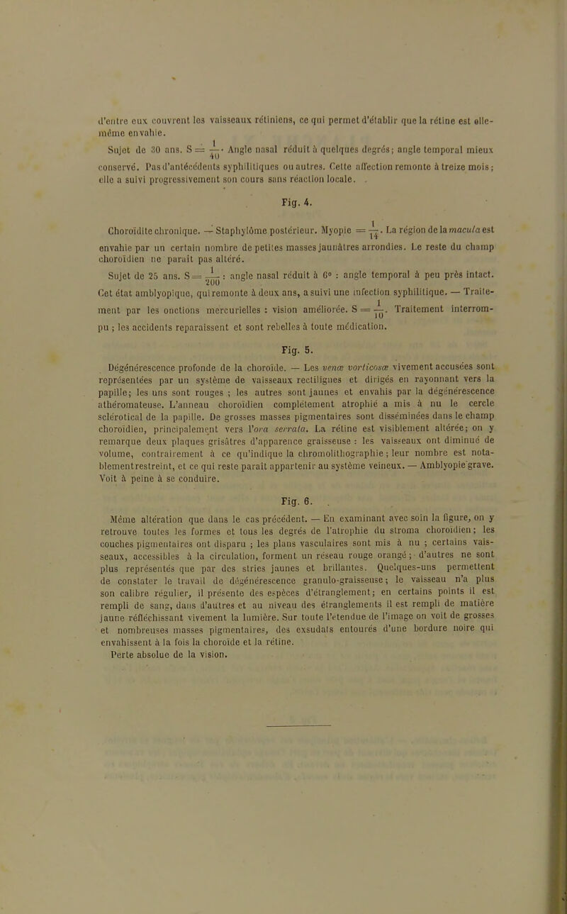 d'entre eux couvrent les vaisseaux rétiniens, ce qui permet d'établir que la rétine est elle- même en valiie. Sujet de 30 ans. S == ^> Angle nasal réduit à quelques degrés; angle temporal mieux conservé. Pas d'antécédents syphilitiques ouautrc3. Cette affection remonte à treize mois ; elle a suivi progressivement son cours sans réaction locale. . Fig. 4. Choroïdite chronique. — Staphylùme postérieur. Myopie =y£- La région delà macula est envahie par un certain nombre de petites masses jaunâtres arrondies. Le reste du champ choroïdien ne paraît pas altéré. Sujet de 25 ans. S= ^ : angle nasal réduit à G0 : angle temporal à peu près intact. Cet état amblyopique, qui remonte à deux ans, a suivi une infection syphilitique. — Traile- ment par les onctions mercurielles : vision améliorée. S == Traitement interrom- pu ; le3 accidents reparaissent et sont rebelles à toute médication. Fig. 5. Dégénérescence profonde de la choroïde. — Les venœ vorticosœ vivement accusées sont représentées par un système de vaisseaux rectilignes et dirigés en rayonnant vers la papille; les uns sont rouges ; les autres sont jaunes et envahis par la dégénérescence athéromateuse. L'anneau choroïdien complètement atrophié a mis à nu le cercle sclérotical de la papille. De grosses masses pigmentaires sont disséminées dans le champ choroïdien, principalement vers l'ora serrata. La réline est visiblement altérée; on y remarque deux plaques grisâtres d'apparence graisseuse : les vaisseaux ont diminué de volume, contrairement à ce qu'indique la chromolithographie ; leur nombre est nola- blementrestreint, et ce qui reste paraît appartenir au système veineux. — Amblyopie'grave. Voit à peine à se conduire. Fig. 6. Même altération que dans le cas précédent. — En examinant avec soin la figure, on y retrouve toutes les formes et tous les degrés de l'atrophie du slroma choroïdien; les couches pigmentaires ont disparu ; les plans vasculaires sont mis à nu ; certains vais- seaux, accessibles à la circulation, forment un réseau rouge orangé; d'autres ne sont plus représentés que par des stries jaunes et brillantes. Quelques-uns permettent de constater le travail de dégénérescence granulo-graisseuse ; le vaisseau n'a plus son calibre régulier, il présente des espèces d'étranglement; en certains points il est rempli de sang, dans d'autres et au niveau des étranglements il est rempli de matière jaune réfléchissant vivement la lumière. Sur toute l'étendue de l'image on voit de grosses et nombreuses masses pigmentaires, des exsudais entourés d'une bordure noire qui envahissent à la fois la choroïde et la rétine. Perte absolue de la vision.