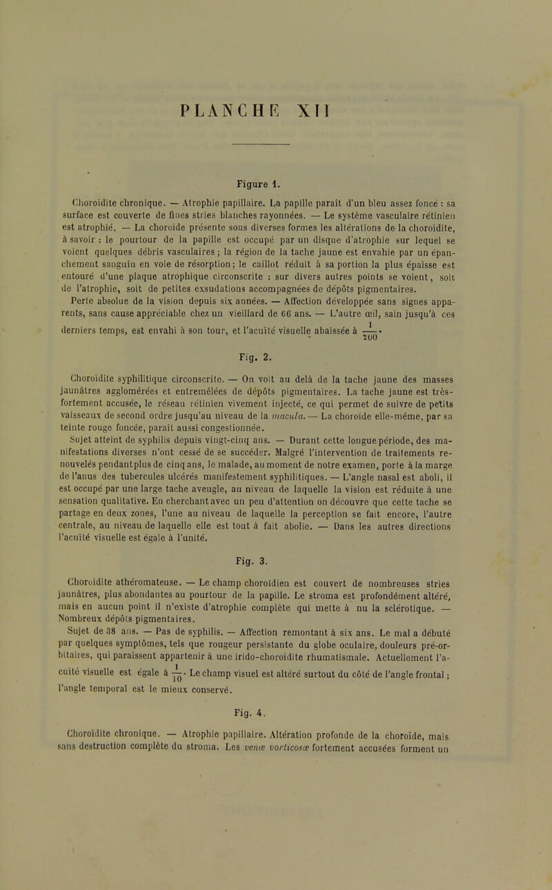 Figure l. Choroïdite chronique. — Atrophie papillaire. La papille paraît d'un bleu assez foncé : sa surface est couverte de fines stries blanches rayonnées. — Le système vasculaire rétinien est atrophié. — La choroïde présente sous diverses formes les altérations de la choroïdite, à savoir : le pourtour de la papille est occupé par un disque d'atrophie sur lequel se voient quelques débris vasculaires ; la région de la tache jaune est envahie par un épan- chement sanguin en voie de résorption; le caillot réduit à sa portion la plus épaisse est entouré d'une plaque atrophique circonscrite : sur divers autres points se voient, soit de l'atrophie, soit de petites exsudations accompagnées de dépôts pigmentaires. Perte absolue de la vision depuis six années. — Affection développée sans signes appa- rents, sans cause appréciable chez un vieillard de 66 ans. — L'autre œil, sain jusqu'à ces derniers temps, est envahi à son tour, et l'acuité visuelle abaissée à -î-r» 1 2U0 Fig. 2. Choroïdite syphilitique circonscrite. — On voit au delà de la tache jaune des masses jaunâtres agglomérées et entremêlées de dépôts pigmentaires. La tache jaune est très- fortement accusée, le réseau rétinien vivement injecté, ce qui permet de suivre de petits vaisseaux de second ordre jusqu'au niveau de la macula. — La choroïde elle-même, par sa teinte rouge foncée, parait aussi congestionnée. Sujet atteint de syphilis depuis vingt-cinq ans. — Durant cette longue période, des ma- nifestations diverses n'ont cessé de se succéder. Malgré l'intervention de traitements re- nouvelés pendantplus de cinq ans, le malade, au moment de notre examen, porte à la marge de l'anus des tubercules ulcérés manifestement syphilitiques. — L'angle nasal est aboli, il est occupé par une large tache aveugle, au niveau de laquelle la vision est réduite à une sensation qualitative. En cherchant avec un peu d'attention on découvre que celte tache se partage en deux zones, l'une au niveau de laquelle la perception se fait encore, l'autre centrale, au niveau de laquelle elle est tout à fait abolie. — Dans les autres directions l'acuité visuelle est égale à l'unité. Fig. 3. Choroïdite athéromateuse. — Le champ choroïdien est couvert de nombreuses stries jaunâtres, plus abondantes au pourtour de la papille. Le stroma est profondément altéré, mais en aucun point il n'existe d'atrophie complète qui mette à nu la sclérotique. — Nombreux dépôts pigmentaires. Sujet de 38 ans. — Pas de syphilis. — Affection remontant à six ans. Le mal a débuté par quelques symptômes, tels que rougeur persistante du globe oculaire, douleurs pré-or- bitaires, qui paraissent appartenir à une irido-choroïdite rhumatismale. Actuellement l'a- cuité visuelle est égale à -j^- Le champ visuel est altéré surtout du côté de l'angle frontal ; l'angle temporal est le mieux conservé. Fig. 4. Choroïdite chronique. — Atrophie papillaire. Altération profonde de la choroïde, mais Bans destruction complète du stroma. Les venœ vorticosœ fortement accusées forment un