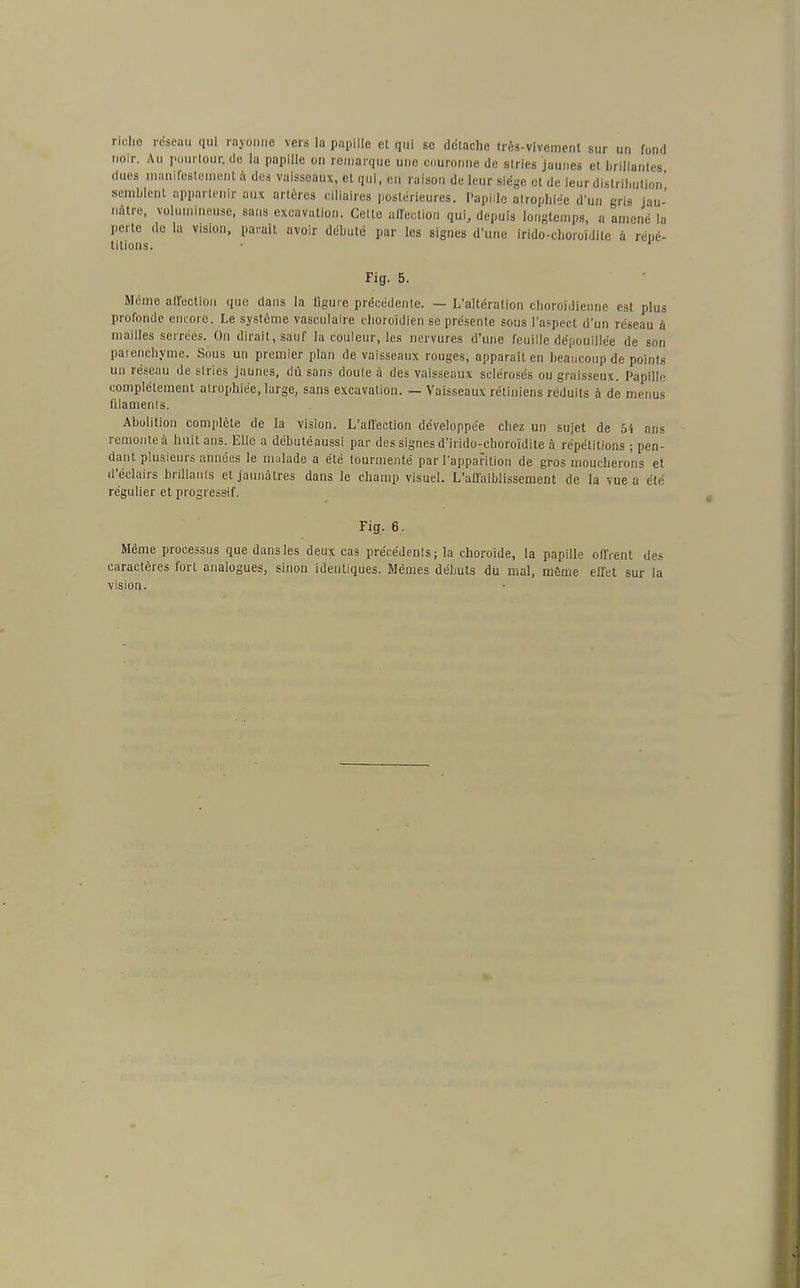 riche réseau qui rayonne vers la papille et qui se détache très-vivement sur un fond noir. Au pourtour, de la papille on remarque une couronne de stries jaunes et brillantes dues manifestement à des vaisseaux, et qui, en raison de leur siège et de leur distribution' semblent appartenir aux ortères ciliaires postérieures. Papille atrophiée d'un gris jau- nâtre, volumineuse, sans excavation. Celte affection qui, depuis longtemps, a amené la perte de la vision, paraît avoir débuté par les signes d'une irido-choroïdite à répé- titions. • Fig. 5. Môme affection que dans la ligure précédente. — L'altération choroïdienne est plus profonde encore. Le système vasculaire choroïdien se présente sous l'aspect d'un réseau à mailles serrées. On dirait, sauf la couleur, les nervures d'une feuille dépouillée de son parenchyme. Sous un premier plan de vaisseaux rouges, apparaît en beaucoup de points un réseau de stries jaunes, dû sans doule à des vaisseaux sclérosés ou graisseux. Papille complètement atrophiée, large, sans excavation. — Vaisseaux rétiniens réduits à de menus filaments. Abolition complète de la vision. L'affection développée chez un sujet de 5i ans remonte à huit ans. Elle a débutéaussi par des signes d'irido-choroïdite à répétitions ; pen- dant plusieurs années le malade a été tourmenté par l'apparition de gros moucherons et d'éclairs brillants et jaunâtres dans le champ visuel. L'affaiblissement de la vue a été régulier et progressif. Fig. 6. Même processus que dans les deux cas précédents; la choroïde, la papille offrent des caractères fort analogues, sinon identiques. Mêmes débuts du mal, môme effet sur la vision.