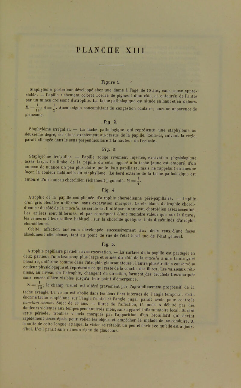 Figure 1. ' Staphylôme postérieur développé chez une dame à l'âge de 40 ans, sans cause appré- ciable. — Papille richement colorée bordée de pigment d'un côté, et entourée de l'autre par un mince croissant d'atrophie. La tache pathologique est située en haut et en dehors. M =Yî> S = â' Aucun siSne concomittant de congestion oculaire; aucune apparence de glaucome. Fig. 2. Staphylôme irrégulier. — La tache pathologique, qui représente une staphylôme au deuxième degré, est située exactement au-dessus de la papille. Celle-ci, suivant la règle, paraît allongée dans le sens perpendiculaire à la hauteur de l'ectasie. Fig. 3. Staphylôme irrégulier. — Papille rouge vivement injectée, excavation physiologique assez large. Le limbe de la papille du côté opposé à la tache jaune est entouré d'un anneau de nuance un peu plus claire que le tissu papillaire, mais ne rappelant en aucune façon la couleur habituelle du staphylôme. Le bord externe de la tache pathologique est entouré d'un anneau choroïdien richement pigmenté. M = -• 4 Fig. 4. Atrophie de la papille compliquée d'atrophie choroïdienne péri-papillaire. — Papille d'un gris bleuâlre uniforme, sans excavation marquée. Cercle blanc d'atrophie choroï- dienne : du côté de la macula, ce cercle estlimitépar unanneau choroïdien assez accentué. Les artères sont filiformes, et par conséquent d'une moindre valeur que sur la figure ; les veines ont leur calibre habituel ; sur la choroïde quelques ilôts disséminés d'atrophié choroïdienne. Cécité, affection ancienne développée successivement aux deux yeux d'une façon absolument silencieuse, tant au point de vue de l'état local que de l'état général. Fig. 5. Atrophie papillaire partielle avec excavation. - La surface de la papille est partagée en deux parties: l'une beaucoup plus large et située du côté de la macula a une teinte grise bleuâtre, uniforme comme dans l'atrophie glaucomateuse ; l'autre plus étroite a conservé sa couleur physiologique et représente ce qui reste de la couche des fibres. Les vaisseaux réti- niens, au niveau de l'atrophie, changent de direction, forment des crochets très-marqués sans cesser d'être visibles jusqu'à leur point d'émergence. S = ïô' le champ visuel est altéré gravement par l'agrandissement progressif de la tache aveugle. La vision est abolie dans les deux tiers internes de l'angle temporal Celte énorme tache empiétant sur l'angle frontal et l'angle jugal paraît avoir pour centre le punctum cœcum. Sujet de 33 ans. - Durée de l'affection, 15 mois. A débuté par des douleurs violentes aux tempes pendant trois mois, sans appareil inflammatoire local Durant cette période, troubles visuels marqués par l'apparition d'un brouillard qui devint rapidement assez épais pour voiler les objets et empêcher le malade de se conduire A la suite de cette longue attaque, la vision se rétablit un peu et devint ce qu'elle est aujour- d'hui. L'œil parait sain : aucun signe de glaucome. I