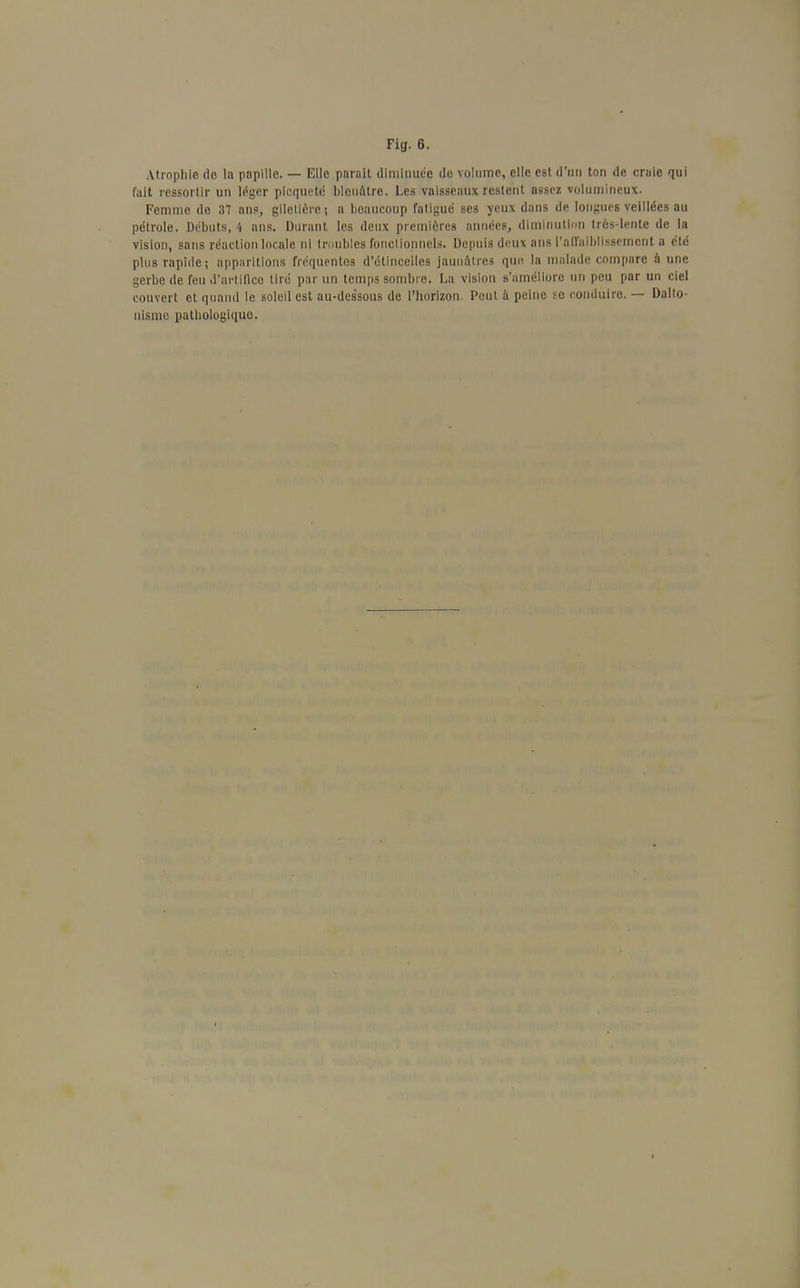 Fig. 6. Atrophie de la papille. — Elle pnrait diminuée de volume, elle est d'un ton de craie qui fait ressortir un léger picqueté bleuâtre. Les vaisseaux restent assez volumineux. Femme de 37 ans, giletiere ; a beaucoup fatigué ses veux dans de longues veillées au pétrole. Débuts, 4 ans. Durant les deux premières années, diminution très-lente de la vision, sans réaction locale ni troubles fonctionnels. Depuis deux ans l'affaiblissement a été plus rapide; apparitions fréquentes d'étincelles jaunâtres que. la malade compare à une gerbe de feu d'artifice tiré par un temps sombre. La vision s'améliore un peu par un ciel couvert et quand le soleil est au-des*sous de l'horizon. Peut à peine se conduire. — Dalto- nisme pathologique.