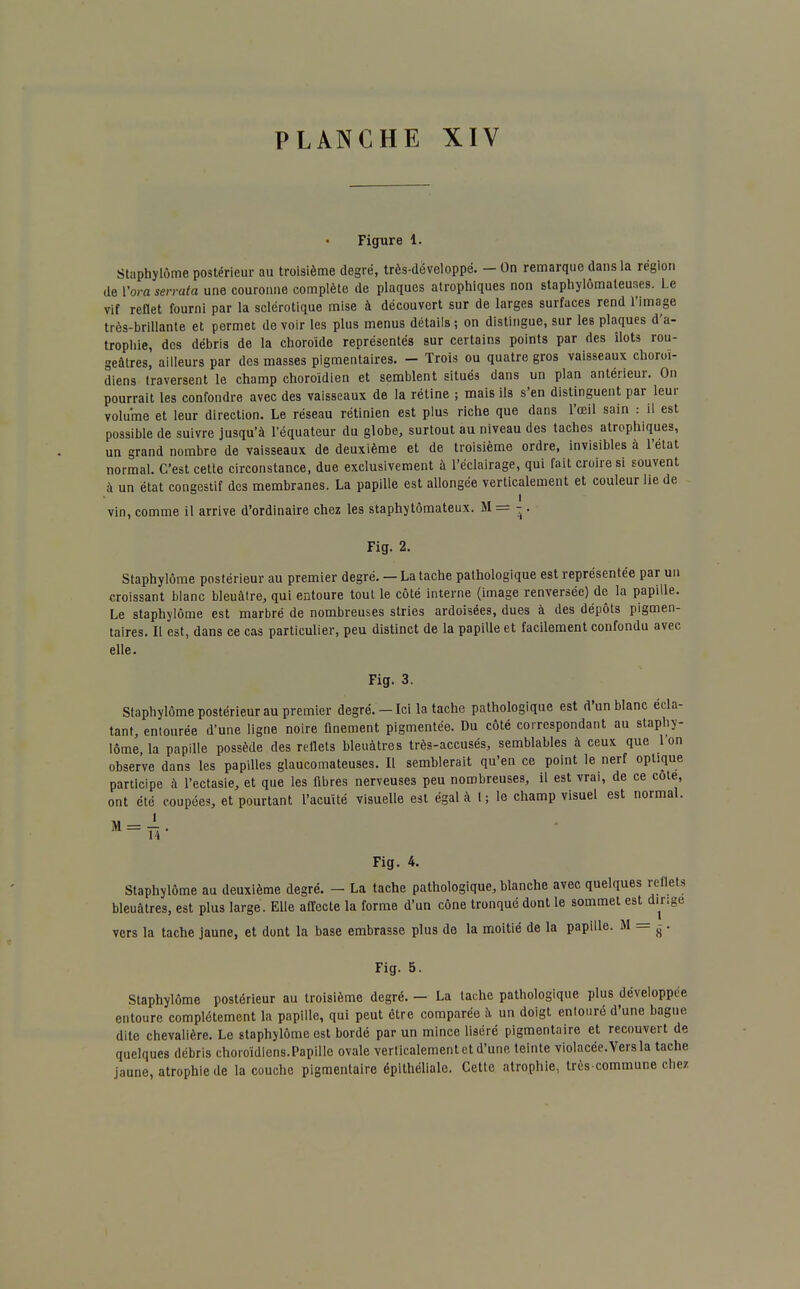 Figure 1. Staphylôme postérieur au troisième degré, très-développé. - On remarque dans la région de Vora serrata une couronne complète de plaques atrophiques non staphylômaleuses. Le vif reflet fourni par la sclérotique mise à découvert sur de larges surfaces rend l'image très-brillante et permet de voir les plus menus détails ; on distingue, sur les plaques d'a- trophie, des débris de la choroïde représentés sur certains points par des îlots rou- geàtres, ailleurs par des masses pigmentaires. - Trois ou quatre gros vaisseaux choroi- diens traversent le champ choroidien et semblent situés dans un plan antérieur. On pourrait les confondre avec des vaisseaux de la rétine ; mais ils s'en distinguent par leur volume et leur direction. Le réseau rétinien est plus riche que dans l'œil sain : il est possible de suivre jusqu'à l'équateur du globe, surtout au niveau des taches atrophiques, un grand nombre de vaisseaux de deuxième et de troisième ordre, invisibles à l'état normal. C'est cette circonstance, due exclusivement à l'éclairage, qui fait croire si souvent à un état congestif des membranes. La papille est allongée verticalement et couleur lie de vin, comme il arrive d'ordinaire chez les staphytômateux. M= - . Fig. 2. Staphylôme postérieur au premier degré. — La tache pathologique est représentée par un croissant blanc bleuâtre, qui entoure tout le côté interne (image renversée) de la papille. Le staphylôme est marbré de nombreuses stries ardoisées, dues à des dépôts pigmen- taires. Il est, dans ce cas particulier, peu distinct de la papille et facilement confondu avec elle. Fig. 3. Staphylôme postérieur au premier degré.-Ici la tache pathologique est d'un blanc écla- tant, entourée d'une ligne noire finement pigmentée. Du côté correspondant au staphy- lôme la papille possède des reflets bleuâtres très-accusés, semblables à ceux que l'on observe dans les papilles glaucomateuses. Il semblerait qu'en ce point le nerf optique participe ù l'ectasie, et que les fibres nerveuses peu nombreuses, il est vrai, de ce cote, ont été coupées, et pourtant l'acuité visuelle est égal à 1; le champ visuel est normal. M = T5 Fig. 4. Staphylôme au deuxième degré. - La tache pathologique, blanche avec quelques reflets bleuâtres, est plus large . Elle affecte la forme d'un cône tronqué dont le sommet est dinge vers la tache jaune, et dont la base embrasse plus de la moitié de la papille. M = g . Fig. 5. Staphylôme postérieur au troisième degré. — La tache pathologique plus développée entoure complètement la papille, qui peut être comparée à un doigt entouré d'une bague dite chevalière. Le staphylôme est bordé par un mince liséré pigmentaire et recouvert de quelques débris choroïdiens.Papille ovale verticalement et d'une teinte violacée. Vers la tache jaune, atrophie de la couche pigmentaire épithéliale. Cette atrophie, très commune chez