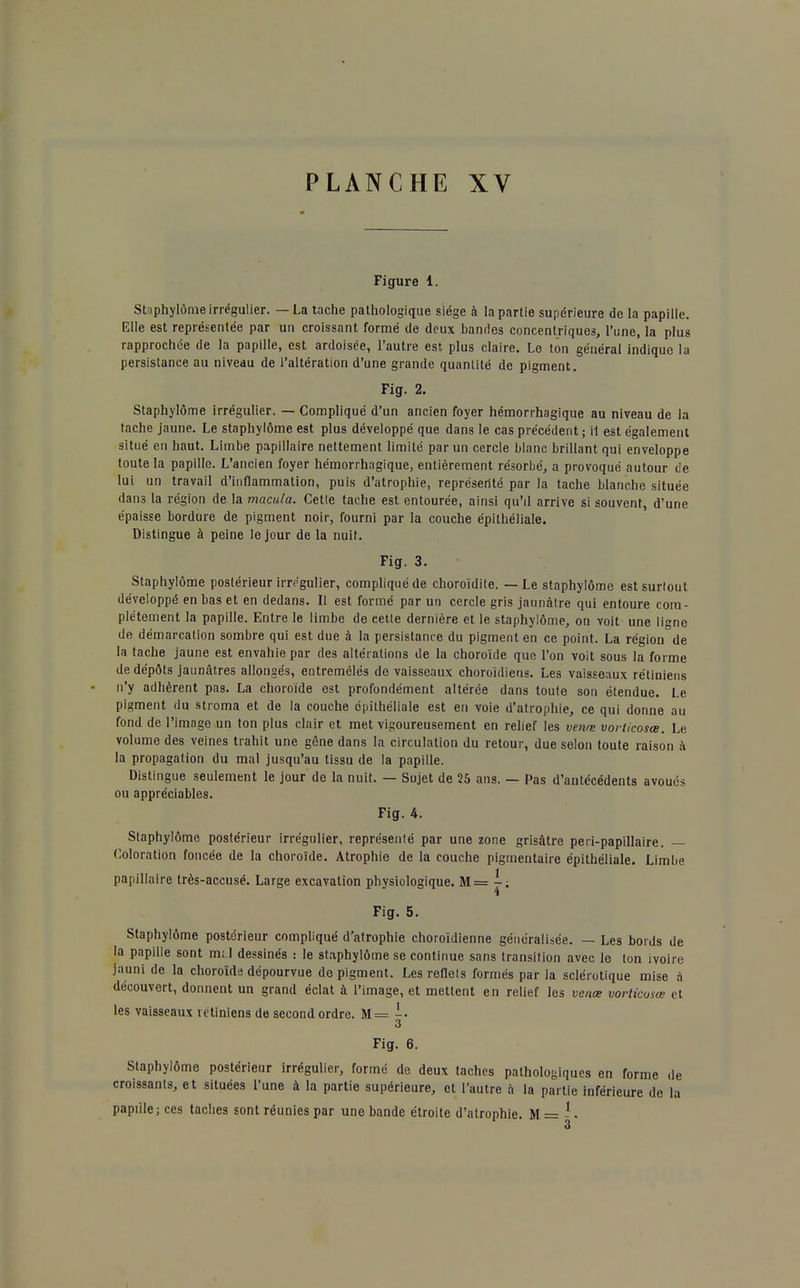 Figure i. Staphylôme irrégulier. — La tache pathologique siège à la partie supérieure de la papille. Elle est représentée par un croissant formé de deux bandes concentriques, l'une, la plus rapprochée de la papille, est ardoisée, l'autre est plus claire. Le ton général indique la persistance au niveau de l'altération d'une grande quantité de pigment. Fig. 2. Staphylôme irrégulier. — Compliqué d'un ancien foyer hémorrhagique au niveau de la tache jaune. Le staphylôme est plus développé que dans le cas précédent; il est également situé en haut. Limbe papillaire nettement limité par un cercle blanc brillant qui enveloppe toute la papille. L'ancien foyer hémorrhagique, entièrement résorbé, a provoqué autour de lui un travail d'inflammation, puis d'atrophie, représenté par la tache blanche située dans la région de la macula. Cetle tache est entourée, ainsi qu'il arrive si souvent, d'une épaisse bordure de pigment noir, fourni par la couche épithéliale. Distingue à peine le jour de la nuit. Fig. 3. Staphylôme postérieur irrégulier, compliqué de choroïdite. — Le staphylôme est surtout développé en bas et en dedans. Il est formé par un cercle gris jaunâtre qui entoure com- plètement la papille. Entre le limbe de eette dernière et le staphylôme, on voit une ligne de démarcation sombre qui est due à la persistance du pigment en ce point. La région de la tache jaune est envahie par des altérations de la choroïde que l'on voit sous la forme de dépôts jaunâtres allongés, entremêlés de vaisseaux choroïdiens. Les vaisseaux rétiniens n'y adhèrent pas. La choroïde est profondément altérée dans toute son étendue. Le pigment du stroma et de la couche épithéliale est en voie d'atrophie, ce qui donne au fond de l'image un ton plus clair et met vigoureusement en relief les venœ voriicosœ. Le volume des veines trahit une gêne dans la circulation du retour, due selon toute raison à la propagation du mal jusqu'au tissu de la papille. Distingue seulement le jour de la nuit. — Sujet de 25 ans. — Pas d'antécédents avoués ou appréciables. Fig. 4. Staphylôme postérieur irrégulier, représenté par une zone grisâtre peri-papillaire. — Coloration foncée de la choroïde. Atrophie de la couche pigmentaire épithéliale. Limbe papillaire très-accusé. Large excavation physiologique. M = -; Fig. 5. Staphylôme postérieur compliqué d'atrophie choroïdienne généralisée. — Les bords de la papille sont nul dessinés : le staphylôme se continue sans transition avec le ton ivoire jauni de la choroïds dépourvue de pigment. Les reflels formés par la sclérotique mise à découvert, donnent un grand éclat à l'image, et mettent en relief les venœ vorticosœ et les vaisseaux rétiniens de second ordre. M = 3 Fig. 6. Staphylôme postérieur irrégulier, formé de deux taches pathologiques en forme de croissants, et situées l'une à la partie supérieure, et l'autre à la partie inférieure de la papille ; ces taches sont réunies par une bande étroite d'atrophie. M=