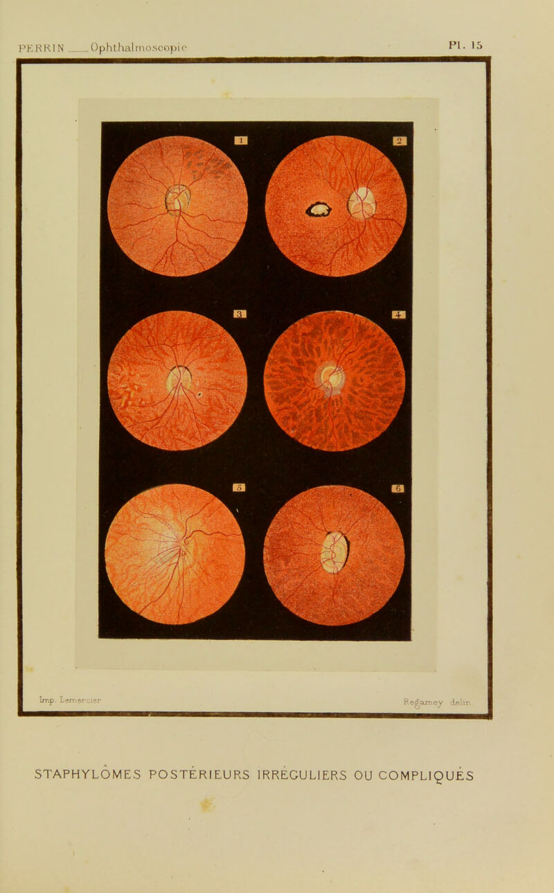 PE RRIN Ophthalmoscopie STAPHYLÔMES POSTÉRIEURS IRRÉGULIERS OU COMPLIQUES