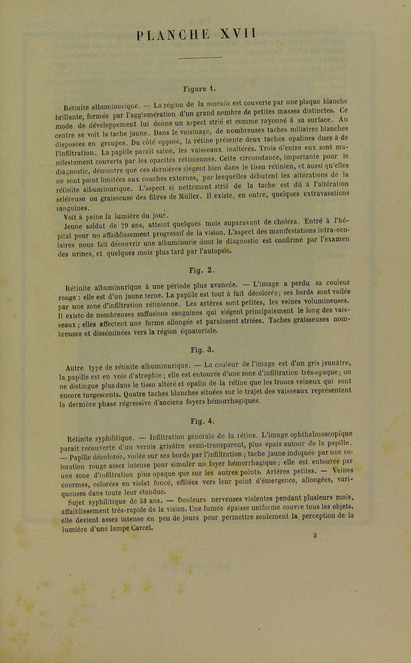 Figure 1. Bélinite albuminurique. - La région de la macula est couverte par une plaque blanche bri ë formée par l'agglomération d'un grand nombre de petites masses d.st.nctes. Ce m de d développement lui donne un aspect strié et comme rayonné à sa surface. Au ce te se v. t la tache jaune. Dans le voisinage, de nombreuses taches m. a,res blanches I s osées en groupes. Du côté opposé, la rétine présente deux tacbes opalines due a de nfl ration. La papille paraît saine, les vaisseaux inaltéré, Trois d'entre eux sont ma- n î Lent couverts par ies opacités rétiniennes. Cette circonstance, importante pour le 3 a-nostic, démontre que ces dernières siègent bien dans le tissu rét.men et aussi qu elles n son po nt limitées aux couches externes, par lesquelles débutent les alteraf ons de la Lite albuminurique. L'aspect si nettement strié de la tache est du a l'altéra .on Srluse ou graisseuse des fibres de Mùller. 11 existe, en outre, quelques extravasations sanguines. Voit à peine la lumière du jour. Jeune soldat de 29 ans, atteint quelques mois auparavant de choiera. Entre à 1 hô- pital pour un affaiblissement progressif de la vision. L'aspect des manifestations intra-ocu- laires nous fait découvrir une albuminurie dont le diagnostic est confirme par 1 examen des urines, et quelques mois plus tard par l'autopsie. Fig. 2. Rétinite albuminurique à une période plus avancée. - L'image a perdu sa couleur rouge • elle est d'un jaune terne. La papille est tout à fait décolorée ; ses bords sont vo.les par une zone d'infiltration rétinienne. Les artères sont petites, les veines volumineuses. II existe de nombreuses suffusions sanguines qui siègent principalement le long des va.s- seaux ; elles affectent une forme allongée et paraissent striées. Taches graisseuses nom- breuses et disséminées vers la région équatoriale. Fig. 3. Autre type de rétinite albuminurique. - La couleur de l'image est d'un gris jaunâtre, la papille est en voie d'atrophie ; elle est entourée d'une zone d'infiltration très-opaque; on ne distingue plus dans le tissu altéré et opalin de la rétine que les troues veineux qui sont encore turgescents. Quatre taches blanches situées sur le trajet des vaisseaux représentent la dernière phase régressive d'anciens foyers hémorrhagiques. Fig. 4. Rétinite syphilitique. - Infiltration générale de la rétine. L'image ophthalmoscopique paraît recouverte d'un vernis grisâtre semi-transparent, plus épais autour de la papille. - Papille décolorée, voilée sur ses bords par l'infiltration ; tache jaune indiquée par une co- loration rouge assez intense pour simuler un foyer hémorrhagique ; elle est entourée par une zone d'infiltration plus opaque que sur les autres points. Artères petites. - Veines énormes, colorées en violet foncé, effilées vers leur point d'émergence, allongées, vari- queuses dans toute leur étendue. Sujet syphilitique de 53 ans. - Douleurs nerveuses violentes pendant plusieurs mois, affaiblissement très-rapide de la vision. Une fumée épaisse uniforme couvre tous les objets, elle devient assez intense en peu de jours pour permettre seulement la. perception de la lumière d'une lampe Carcel. 3