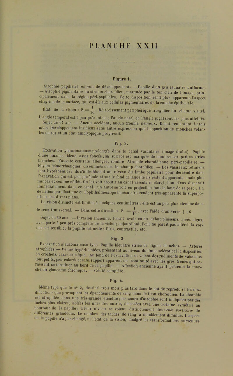 Figure 1. Atrophie papillaire en voie de développement. — Papille d'un gris jaunâtre uniforme. — Atrophie pigmentaire du stroma choroïdien, marquée par le ton clair de l'image, prin- cipalement dans la région péri-papillaire. Cette disposition rend plus apparente l'aspect chagriné de la surface, qui est du aux cellules pigmentaires de la couche épithéliale. Etat de la vision : S = —. Rétrécissement périphérique irrégulier du champ visuel. L'angle temporal est à peu près intact ; l'angle nasal et l'angle jugal sont les plus atteints. Sujet de G7 ans. — Aucun accident, aucun trouble nerveux. Début remontant à trois mois. Développement insidieux sans autre expression que l'apparition de mouches volan- tes noires et un état amblyopique progressif. Fig. 2. Excavation glaucomateuse prolongée dans le canal vasculaire (image droite). Papille d'une nuance bleue assez foncée ; sa surface est marquée de nombreuses petites stries blanches. Fossette centrale allongée, sombre. Atrophie choroïdienne péri-papillaire. — Foyers hémorrhagiques disséminés dans le champ choroïdien. — Les vaisseaux rétiniens sont hypérhémiés; ils s'infléchissent au niveau du limbe papillaire pour descendre dan-i l'excavation qui est peu profonde et sur le fond de laquelle ils restent apparents, mais plus minces et comme effilés. On les voit aboutir au canal vasculaire élargi; l'un d'eux disparaît immédiatement dans ce canal ; un autre se voit en projection tout le long de sa paroi, l.a déviation parallactique et l'ophlhalmoscope binoculaire rendent très-apparente la superpo- sition des divers plans. La vision distincte est limitée à quelques centimètres ; elle est un peu plus étendue dans le sens transversal. — Dans cette direction S = —, avec l'aide d'un verre -f 1C. Sujet de 69 ans. — Invasion ancienne. Paraît avoir eu au début plusieurs accès aigus avec perte à peu près complète de la vishon; aujourd'hui, l'œil ne paraît pas altéré; la cor- née est sensible; la pupille est nette ; l'iris, contractile, etc. Fig. 3. E-tcavalion glaucomateuse type. Papille bleuâtre striée de lignes blanches. — Artères atrophiées.—Veines hypérhémiées, présentant au niveau du limbe sclérotical la disposition en crochets, caractéristique. Au fond de l'excavation se voient des rudiments de vaisseaux tout petits, peu colorés et sans rapport apparent de continuité avec les gros troncs qui pa- raissent se terminer au bord de la papille. - Affection ancienne ayant présenté la mar- che du glaucome chronique. — Cécité complète. Fig. 4. Même type que le n° 2, dessiné trois mois plus tard dans le but de reproduire les mo- difications que provoquent les épanchements de sang dans le tissu choroïdien. La choroïde est atrophiée dans une très-grande étendue; les zones d'atrophie sont indiquées par des taches plus claires, isolées les unes des autres, disposées avec une certaine symétrie au pourtour de la papille; à leur niveau se voient distinctement des venœ vorlicosœ de différentes grandeurs. Le nombre des taches de sang a notablement diminué L'aspect do la papille n'a pas changé, ni l'état de la vision, malgré les transformations survenues