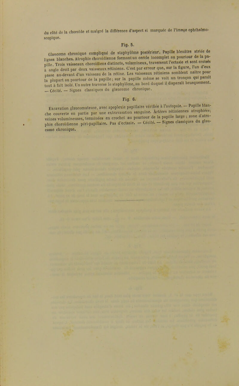 du côté do la choroïde et malgré la différence d'aspect si marquée de l'Image ophthalmo- scoplque. Fig. 5. Glaucome chronique compliqué de staphylôme postérieur. Papille bleuâtre striée de lignes blanches. Atrophie choroïdlenne formant un cercle Incomplet au pourtour de la pa- pille Trois vaisseaux choroïdiens distincts, volumineux, traversent l'ectasle et sont croisés a angio droit par deux vaisseaux rétiniens. C'est par erreur que, sur la figure, l'un d eux passe au-devant d'un vaisseau de la réline. Les vaisseaux rétiniens semblent na.tre pour la plupart au pourtour de la papille; sur la papille même se voit un tronçon qui paraU tout à fait isolé. Un autre traverse le slapbylAmc, au bord duquel il disparaît brusquement. — Cécité. — Signes classiques du glaucome chronique. Fig. 6. Excavation glaucomnteusc, avec apoplexie papillaire vérifiée à l'autopsie. - Papille blan- che couverte en partie par une extravasation sanguine. Artères rétiniennes atrophiée»; veines volumineuses, terminées en crochet au pourtour de la papille large ; zone d atro- phie choroïdlenne péri-papillaire. Pas d'ectasie. - Cécité. - Signes class.ques du glau- come chronique.