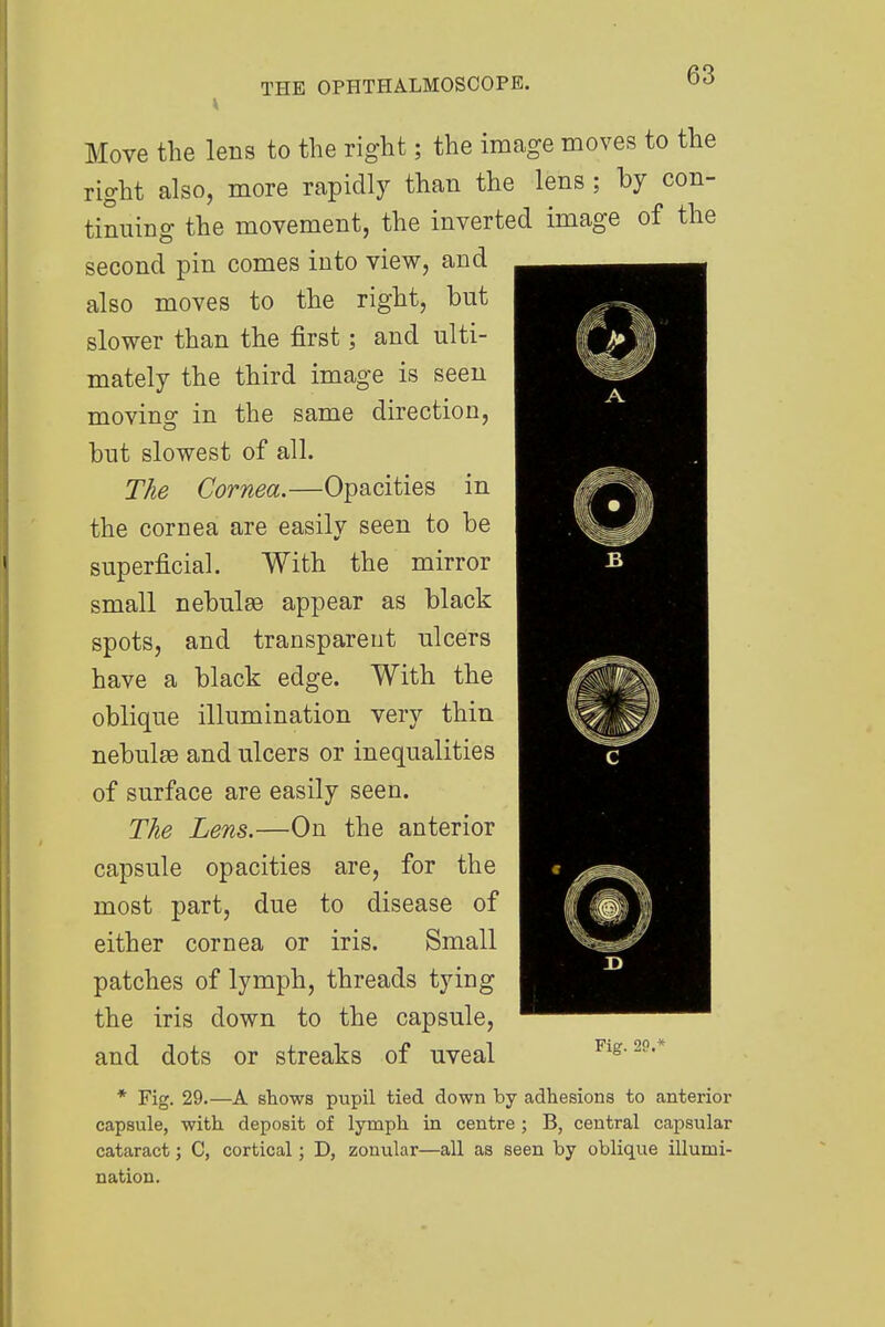 Move the lens to the right; the image moves to the right also, more rapidly than the lens; by con- tinuing the movement, the inverted image of the second pin comes into view, and also moves to the right, but slower than the first; and ulti- mately the third image is seen moving in the same direction, but slowest of all. The Cornea.—Opacities in the cornea are easily seen to be superficial. With the mirror small nebulas appear as black spots, and transparent ulcers have a black edge. With the oblique illumination very thin nebulse and ulcers or inequalities of surface are easily seen. The Lens.—On the anterior capsule opacities are, for the most part, due to disease of either cornea or iris. Small patches of lymph, threads tying the iris down to the capsule, and dots or streaks of uveal * Fig. 29.—A shows pupil tied down by adhesions to anterior capsule, with deposit of lymph in centre ; B, central capsular cataract; C, cortical; D, zonular—all as seen by oblique illumi- nation. Fig. 00 *