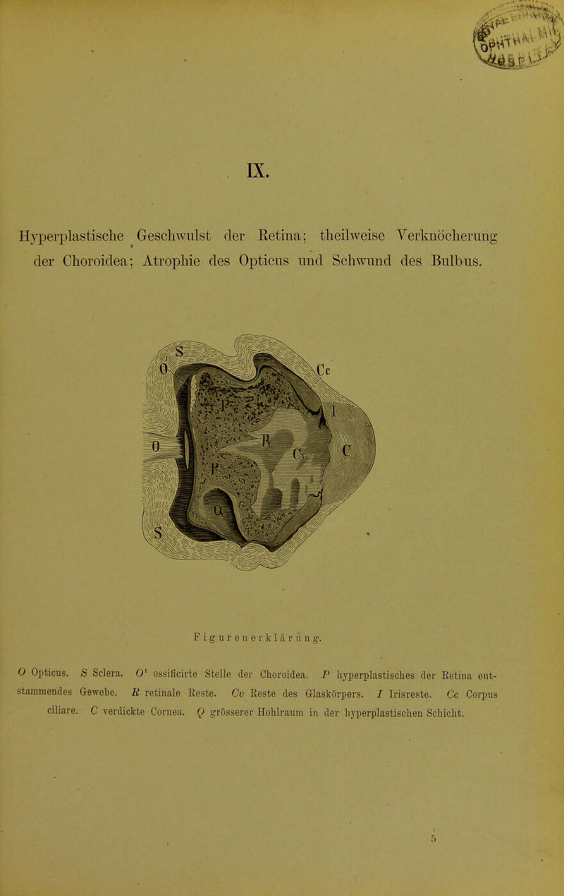 Hyperplastische Geschwulst der Retina; theilweise Verknöcherung der Choroidea; Atrophie des Opticus und Schwund des Bulbus. F i g u r e n e r k 1 ä r u n g. 0 Opticus. 8 Sclera. O1 ossificirte Stelle der Choroidea. P hyperplastisches der Retina ent- stammendes Gewehe. R retinale Eeste. Co Reste des Glaskörpers. I Irisreste. Cc Corpus ciliare. C verdickte Cornea. Q grösserer Hohlraum in der hyperplastischeu Schicht.