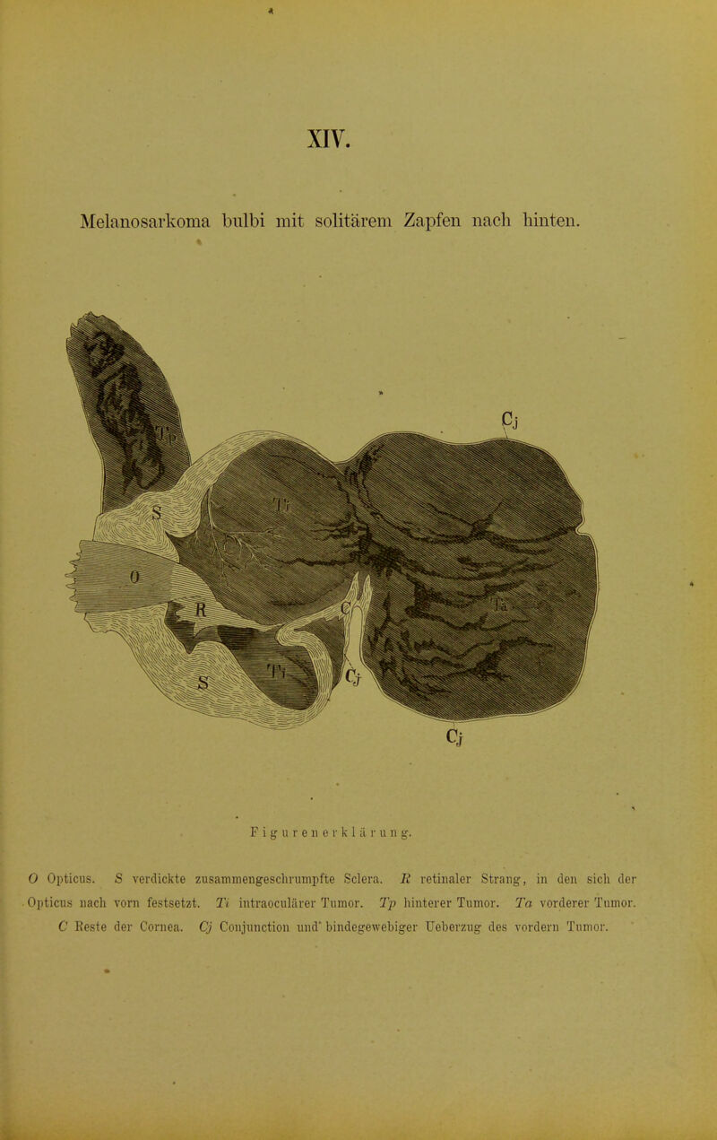 0 Opticus. S verdickte zusammengeschrumpfte Sclera. R retinaler Strang, in den sich der Opticus nach vorn festsetzt. Ti intraokularer Tumor. Tp hinterer Tumor. Ta vorderer Tumor. C Beste der Cornea. Cj Conjunction und' bindegewebiger Ueberzug des vordem Tumor.