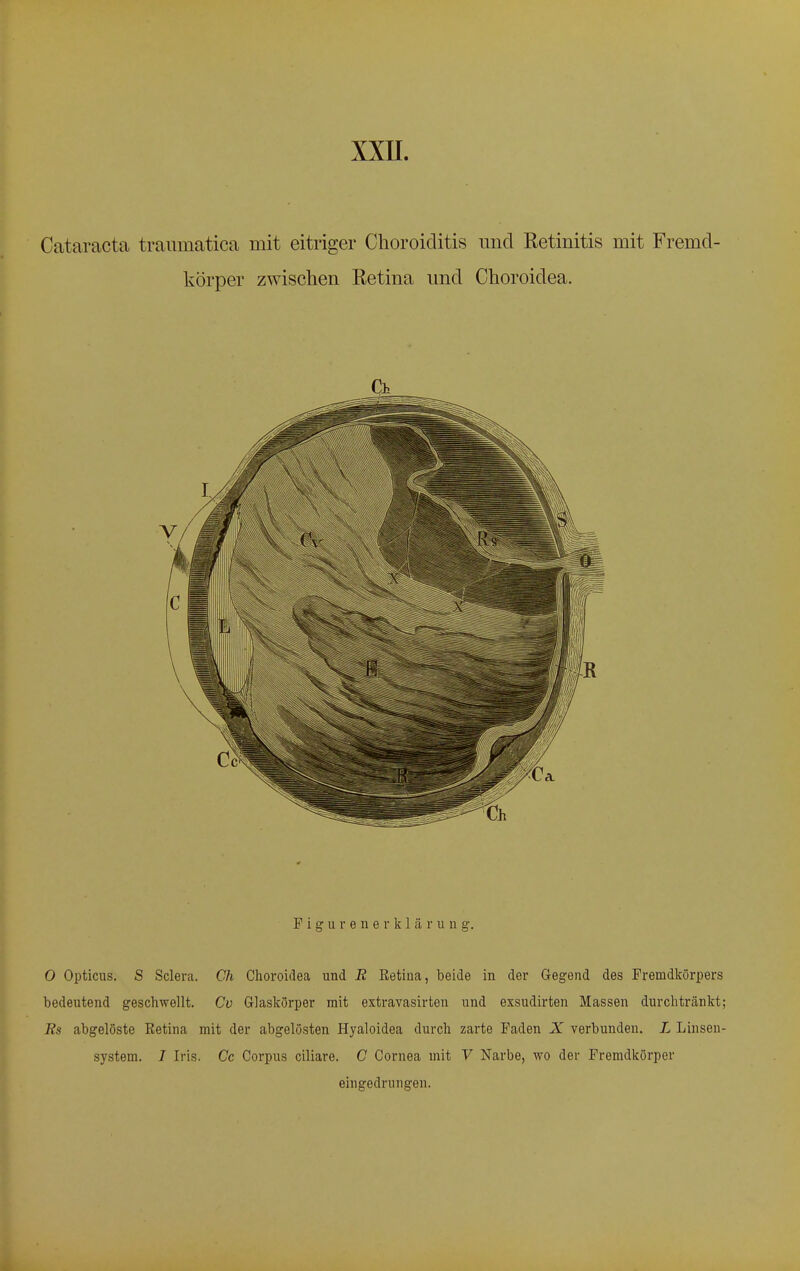 Cataracta traumatica mit eitriger Choroiditis und Retinitis mit Fremd- körper zwischen Retina und Choroidea. Figurenerklärung. 0 Opticus. S Sclera. Ch Choroidea und R Retina, beide in der Gegend des Fremdkörpers bedeutend geschwellt. Cv Glaskörper mit extravasalen und exsudirten Massen durchtränkt; Rs abgelöste Eetina mit der abgelösten Hyaloidea durch zarte Faden X verbunden. L Linsen- system. I Iris. Cc Corpus ciliare. C Cornea mit V Narbe, wo der Fremdkörper eingedrungen.
