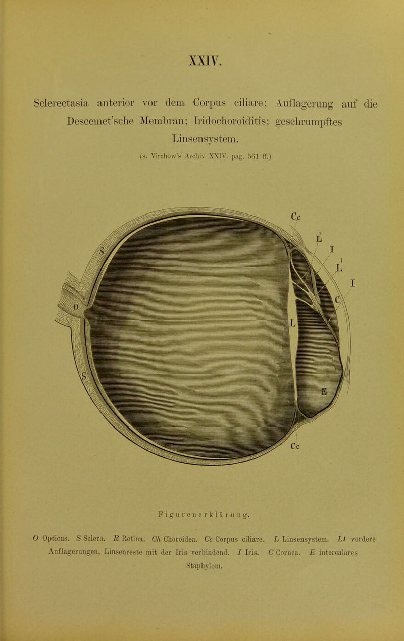 Sclerectasia anterior vor dem Corpus ciliare; Auflagerung auf die Descemet'scke Membran; Tridochoroiditis; geschrumpftes Linsensystem. (s. Virchow's Archiv XXIV. pag. 561 ff.) P i g u r e n e r k 1 ä r u n g. 0 Opticus. S Sclera. R Retina. Ch Choroidea. Cc Corpus ciliare. L Linsensystem. Li vordere Auflagerungen, Linsenreste mit der Iris verbindend. / Iris. C Cornea. E intercalares Staphylom.