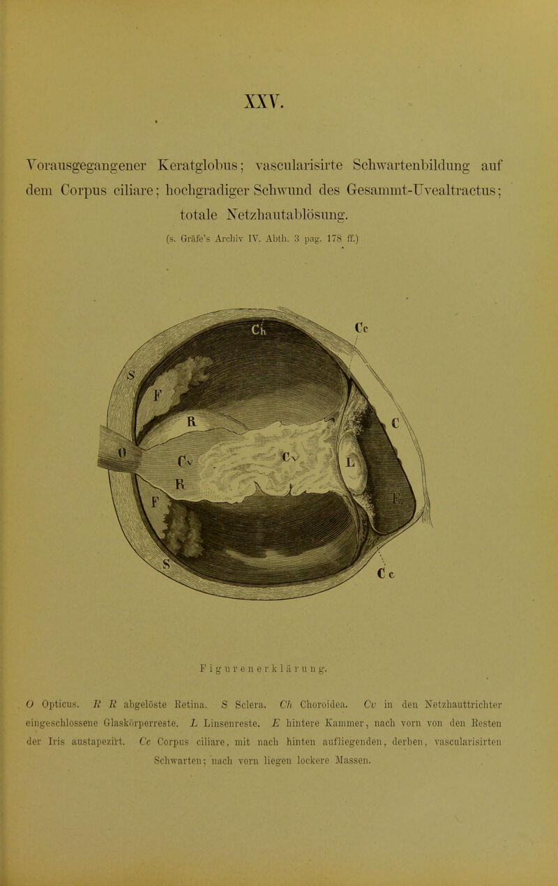 Vorausgegangener Keratglobus; vascularisirte Schwartenbildung auf dem Corpus ciliare; hochgradiger Schwund des Gesammt-Uvealtractus; totale Netzhautablösung. (s. Gräfe's Archiv IV. Abth. 3 pag. 178 ff.) F i g u r e n e v k 1 ii r ü n g. 0 Opticus. Ii R abgelöste Retina. S Sclera. Ch Choroidea. Cv in den Netzhauttrichter eingeschlossene Glaskorperreste. L Linsenreste. E hintere Kammer, nach vorn von den Resten der Iris austapezirt. Cc Corpus ciliare, mit nach hinten aufliegenden, derben, vascularisirten Schwarten; nach vorn liegen lockere Massen.