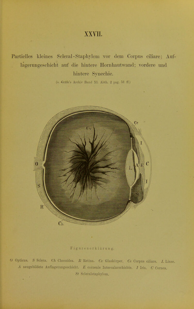 Partielles kleines Scleral-Staphylom vor dem Corpus ciliare; Auf- lagerungesehicht auf die hintere Horntiautwand; vordere und hintere Synechie. (s. Gräfe's Archiv Band XI. Abth. 2 pag. 51 ff.) Figaro n e v k 1 iL r u n g. O Opticus. S Sclera. Ch Choroidea. R Retina. Cd Glaskörper. Cc Corpus ciliare, Z, Linse. A neugebildete Auflagerungsschicht. E corneale Intercalarschiclite. I Iris. C Cornea. St Scleralstapliylom.