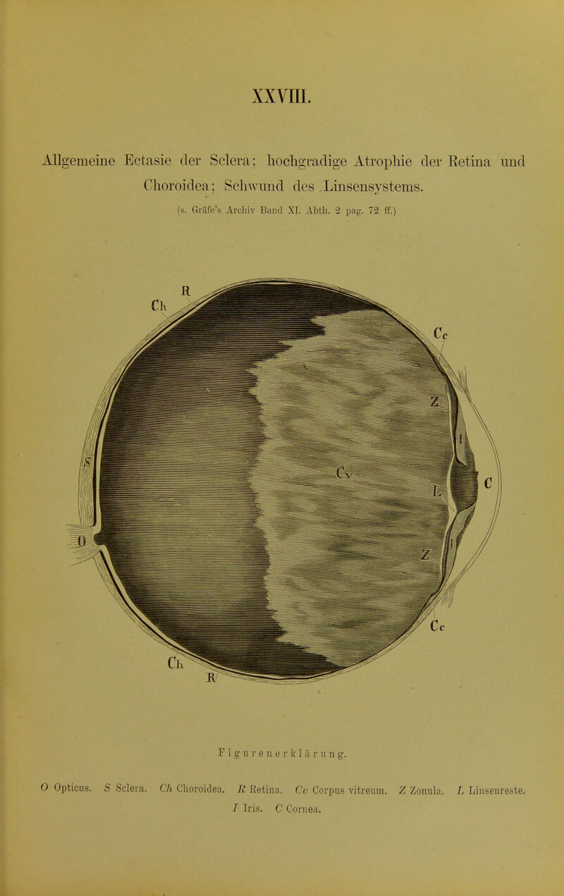 Allgemeine Ectasie der Sclera; hochgradige Atrophie der Retina und Choroidea; Schwund des , Linsensystems. is. Gräfe's Archiv Band XI. Abth. 2 pag. 72 ff.) F i g u r e n e r k 1 ii r u n g. 0 Opticus. S Sclera. Ch Choroidea. E Retina. Co Corpus vitreum. Z Zonula. L Linsenreste. I Iris. C Cornea.