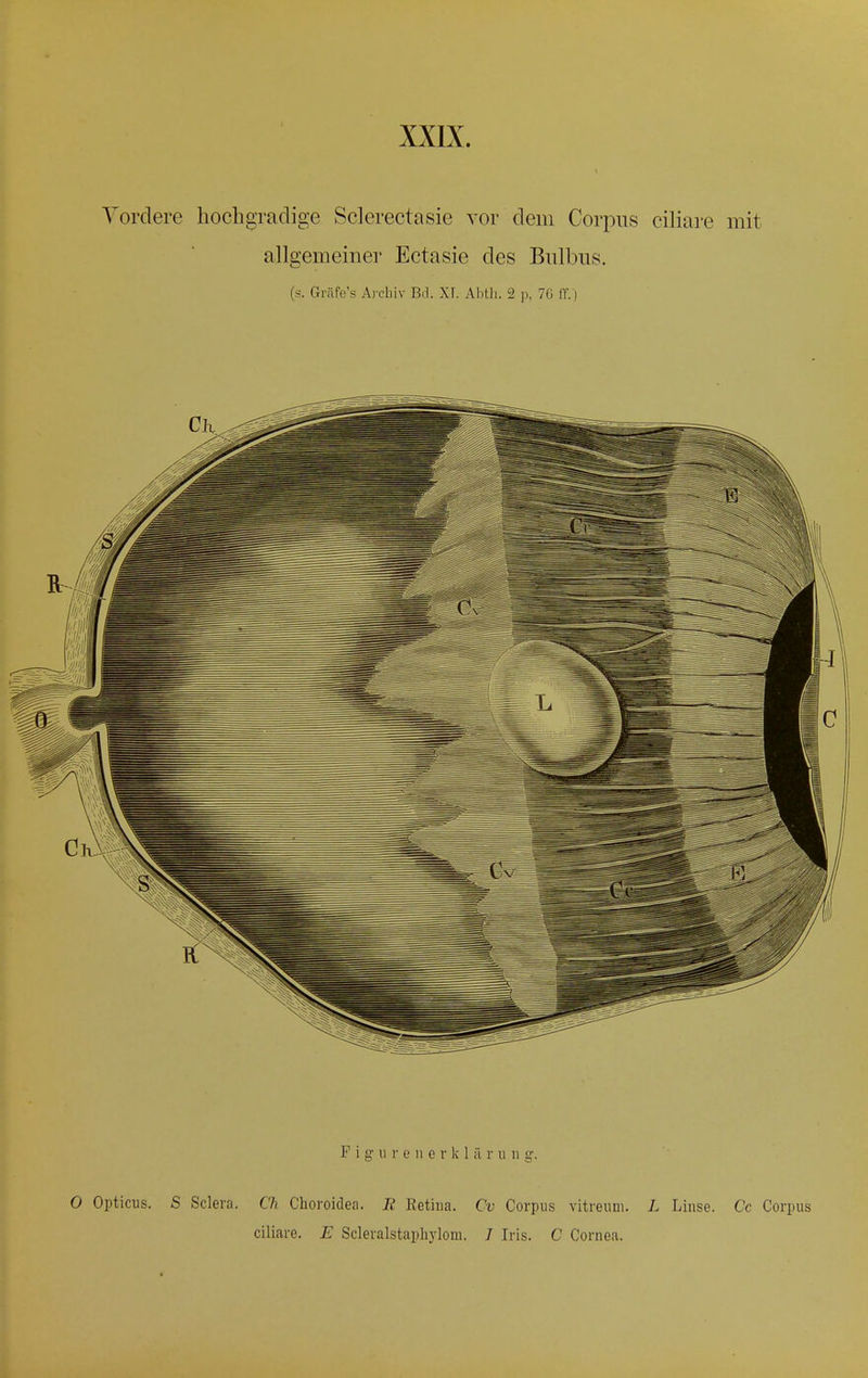 Vordere hochgradige Sclerectasie vor dem Corpus ciliare mit allgemeiner Ectasie des Bulbus. (s. Gräfe's Archiv Bd. XF. Abth. 2 p, 76 ff.) 0 Opticus. S Selera. Ch Choroidea. R Retina. Cv Corpus vitreum. L Linse. Cc Corpus ciliare. E Scleralstaphylom. I Iris. C Cornea.