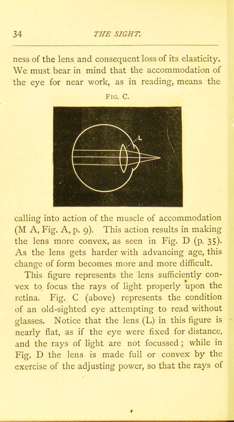 ness of the lens and consequent loss of its elasticity. We must bear in mind that the accommodation of the eye for near work, as in reading, means the Fig. C. calling into action of the muscle of accommodation (M A, Fig, A, p. 9). This action results in making the lens more convex, as seen in Fig. D (p. 35)- As the lens gets harder with advancing age, this change of form becomes more and more difficult. This figure represents the lens sufficiently con- vex to focus the rays of light properly upon the retina. Fig. C (above) represents the condition of an old-sighted eye attempting to read without glasses. Notice that the lens (L) in this figure is nearly flat, as if the eye were fixed for distance, and the rays of light are not focussed ; while in Fig. D the lens is made full or convex by the exercise of the adjusting power, so that the rays of 4