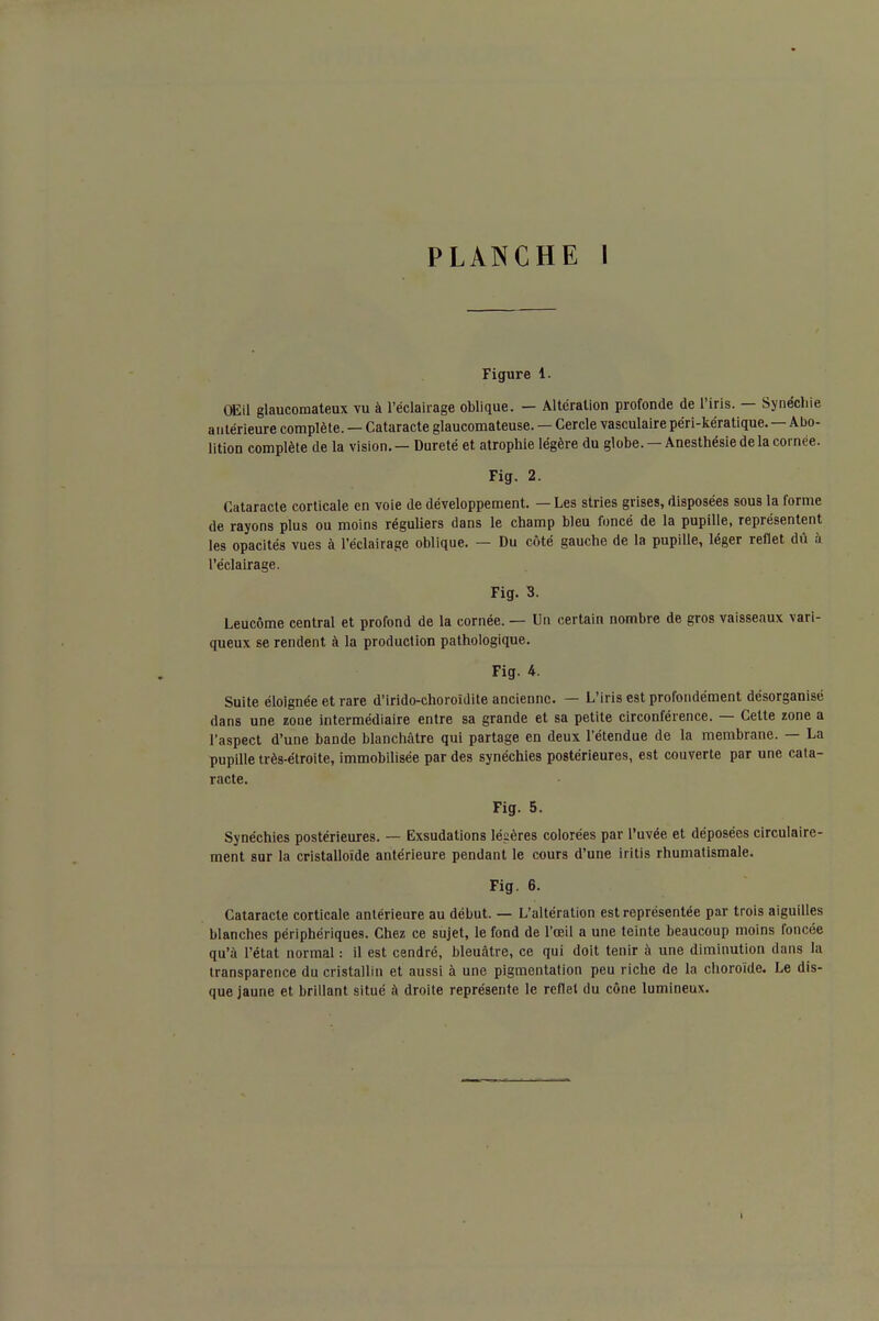 Figure 1. Œil glaucomateux vu à l'éclairage oblique. — Altération profonde de l'iris. — Synéchie antérieure complète. — Cataracte glaucomateuse. — Cercle vasculaire péri-kératique. — Abo- lition complète de la vision. — Dureté et atrophie légère du globe. —Anesthésie de la cornée. Fig. 2. Cataracte corticale en voie de développement. — Les stries grises, disposées sous la forme de rayons plus ou moins réguliers dans le champ bleu foncé de la pupille, représentent les opacités vues à l'éclairage oblique. — Du côté gauche de la pupille, léger reflet dû à l'éclairage. Fig. 3. Leucôme central et profond de la cornée. — Un certain nombre de gros vaisseaux vari- queux se rendent à la production pathologique. Fig. 4. Suite éloignée et rare d'irido-choroidite ancienne. — L'iris est profondément désorganisé dans une zone intermédiaire entre sa grande et sa petite circonférence. — Cette zone a l'aspect d'une bande blanchâtre qui partage en deux l'étendue de la membrane. — La pupille très-étroite, immobilisée par des synéchies postérieures, est couverte par une cata- racte. Fig. 5. Synéchies postérieures. — Exsudations légères colorées par l'uvée et déposées circulaire- ment sur la cristalloïde antérieure pendant le cours d'une iritis rhumatismale. Fig. 6. Cataracte corticale antérieure au début. — L'altération est représentée par trois aiguilles blanches périphériques. Chez ce sujet, le fond de l'œil a une teinte beaucoup moins foncée qu'à l'état normal : il est cendré, bleuâtre, ce qui doit tenir à une diminution dans lu transparence du cristallin et aussi à une pigmentation peu riche de la choroïde. Le dis- que jaune et brillant situé à droite représente le reflet du cône lumineux. 1