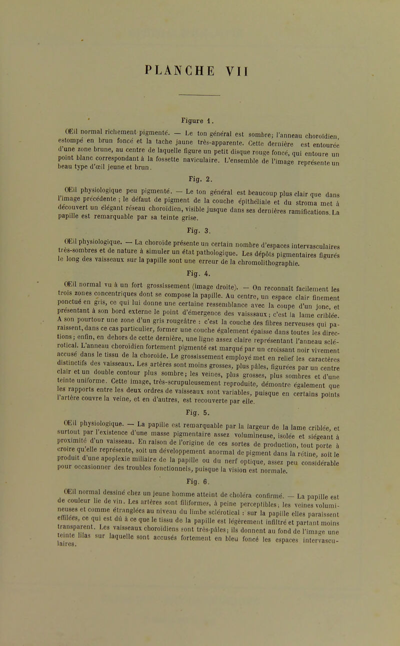 Figure 1. Œil normal richement pigmenté. - Le ton général est sombre; l'anneau choroïdien estompe en brun foncé et la tache jaune très-apparente. Cette dernière est entourée d une zone brune, au centre de laquelle figure un petit disque rouge foncé, qui entoure un pomt blanc correspondant à la fossette naviculaire. L'ensemble de l'image représente un beau type d'œil jeune et brun. ^ représente un Fig. 2. OEil physiologique peu pigmenté. - Le ton général est beaucoup plus clair que dans limage précédente ; le défaut de pigment de la couche épithéliale et du stroma met à découvert un élégant réseau choroïdien, visible jusque dans ses dernières ramifications La papille est remarquable par sa teinte grise. Fig. 3. OEil physiologique. - La choroïde présente un certain nombre d'espaces intervasculaires tres-sombres et de nature à simuler un état pathologique. Les dépôts pigmentaires figurés le long des vaisseaux sur la papille sont une erreur de la chromolithographie. Fig. 4. OEil normal vu à un fort grossissement (image droite). - On reconnaît facilement les trois zones concentriques dont se compose la papille. Au centre, un espace clair finement ponctue en gris, ce qui lui donne une certaine ressemblance avec la coupe d'un jonc et présentant à son bord externe le point d'émergence des vaisssaux; c'est la lame criblée A son pourtour une zone d'un gris rougeâtre : c'est la couche des fibres nerveuses qui pa- raissent, dans ce cas particulier, former une couche également épaisse dans toutes les direc- tions; enfin, en dehors de cette dernière, une ligne assez claire représentant l'anneau sclé- roticaL L anneau choroïdien fortement pigmenté est marqué par un croissant noir vivement accuse dans le tissu de la choroïde. Le grossissement employé met en relief les caractères distinct,fs des vaisseaux. Les artères sont moins grosses, plus pâles, figurées par un centre clair et un double contour plus sombre; les veines, plus grosses, plus sombres et d'une einte uniforme. Cette image, très-scrupuleusement reproduite, démontre également que es rapports entre les deux ordres de vaisseaux sont variables, puisque en certains points 1 artère couvre la veine, et en d'autres, est recouverte par elle. Fig. 5. OEil physiologique. - La papille est remarquable par la largeur de la lame criblée, et surtout par i existence d'une masse pigmentaire assez volumineuse, isolée et siégeant à proximité dun vaisseau. En raison de l'origine de ces sortes de production, tout porte à croire qu elle représente, soit uu développement anormal de pigment dans la rétine soit le produit d une apop exie miliaire de la papille ou du nerf optique, assez peu cens dérable pour occasionner des troubles fonctionnels, puisque la vision est normale. Fig. 6. OEil normal dessiné chez un jeune homme atteint de choléra confirmé. - La papille est de couleur lie de vin. Les artères sont filiformes, à peine perceptibles -, les veines volumi- neuses et comme étranglées au niveau du limbe sclérotical : sur la papille elles paraissent emiees, ce qui est du à ce que le tissu de la papille est légèrement infiltré et partant moins ransparent. Les vaisseaux clioroïdiens sont très-pàles; ils donnent au fond de l'image une teinte hlas sur laquelle sont accusés fortement en bleu foncé les espaces intervascu-