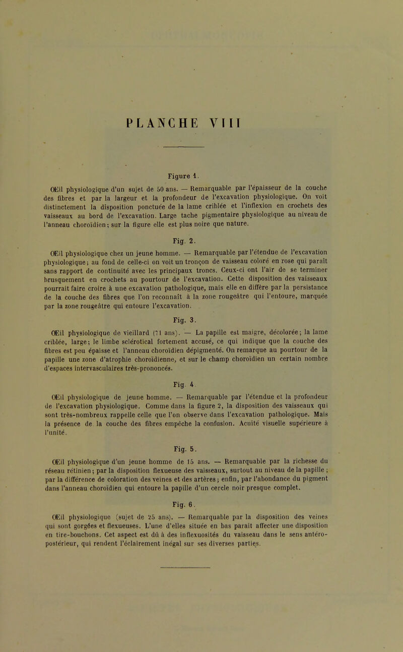 Figure 1. Œil physiologique d'un sujel de 50 ans. — Remarquable par l'épaisseur de la couche des flbres et par la largeur et la profondeur de l'excavation physiologique. On voit distinctement la disposition ponctuée de la lame criblée et l'inflexion en crochets des vaisseaux au bord de l'excavation. Large tache pigmentaire physiologique au niveau de l'anneau choroidien; sur la figure elle est plus noire que nature. Fig. 2. Œ\\ physiologique chez un jeune homme. — Remarquable par l'étendue de l'excavation physiologique; au fond de celle-ci on voit un tronçon de vaisseau coloré en rose qui paraît sans rapport de continuité avec les principaux troncs. Ceux-ci ont l'air de se terminer brusquement en crochets au pourtour de l'excavation. Cette disposition des vaisseaux pourrait faire croire à une excavation pathologique, mais elle en diffère par la persistance de la couche des fibres que l'on reconnaît à la zone rougeàtre qui l'entoure, marquée par la zone rougeàtre qui entoure l'excavation. Fig. 3. Œil physiologique de vieillard (71 ans). — La papille est maigre, décolorée; la lame criblée, large; le limbe sclérotical fortement accusé, ce qui indique que la couche des fibres est peu épaisse et l'anneau choroidien dépigmenté. On remarque au pourtour de la papille une zone d'atrophie choroidienne, et sur le champ choroidien un certain nombre d'espaces intervasculaires très-prononcés. Fig 4 Œil physiologique de jeune homme. — Remarquable par l'étendue et la profondeur de l'excavation physiologique. Comme dans la figure 2, la disposition des vaisseaux qui sont très-nombreux rappelle celle que l'on observe dans l'excavation pathologique. Mais la présence de la couche des flbres empêche la confusion. Acuité visuelle supérieure à l'unité. Fig. 5. Œil physiologique d'un jeune homme de 15 ans. — Remarquable par la richesse du réseau rétinien ; par la disposition flexueuse des vaisseaux, surtout au niveau de la papille ; par la différence de coloration des veines et des artères ; enfin, par l'abondance du pigment dans l'anneau choroidien qui entoure la papille d'un cercle noir presque complet. Fig. 6. Œil physiologique (sujet de 25 ans). — Remarquable par la disposition des veines qui sont gorgées et flexueuses. L'une d'elles située en bas parait afl'ecter une disposition en tire-bouchons. Cet aspect est dû à des inflexuosités du vaisseau dans le sens antéro- postérieur, qui rendent l'éclairement inégal sur ses diverses parties.