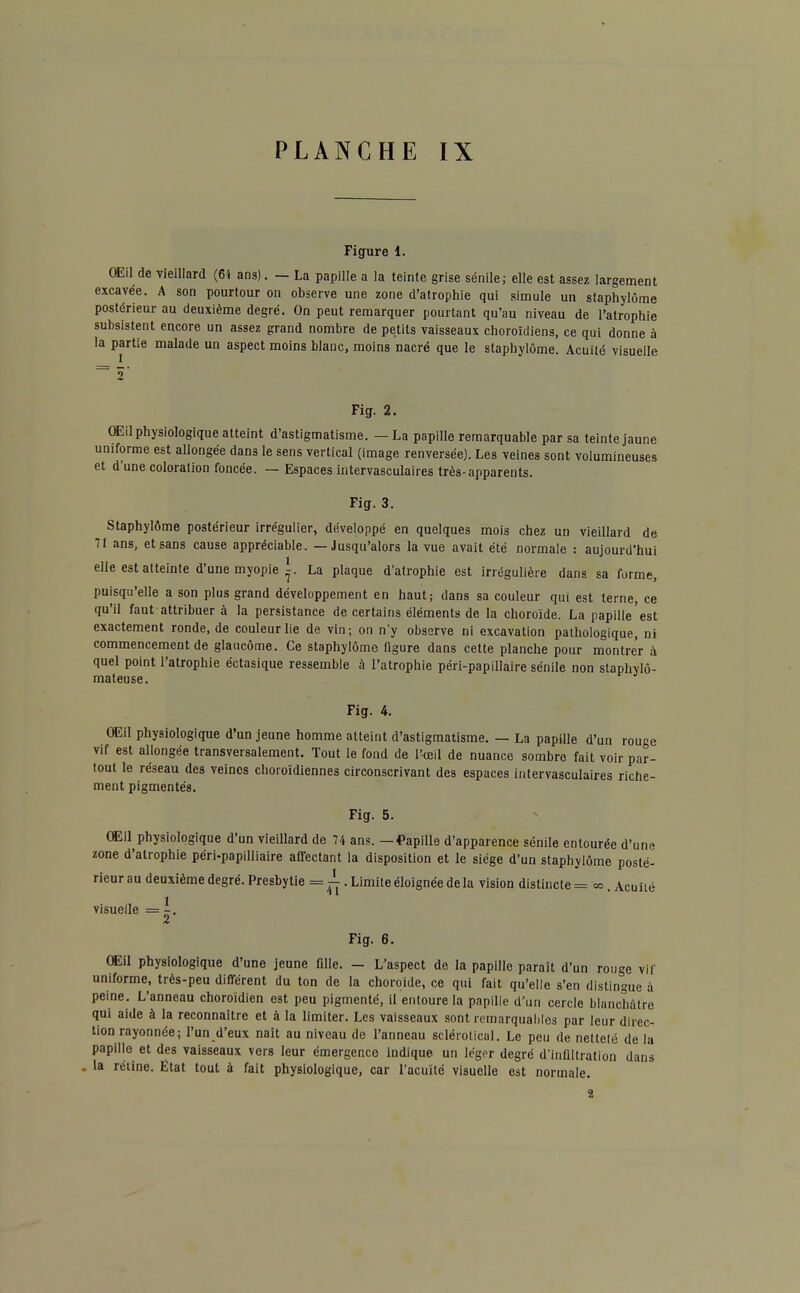 Figure 1. OEil de vieillard (6i ans). — La papille a la teinte grise sénile; elle est assez largement excavée. A son pourtour on observe une zone d'atrophie qui simule un staphylôme postérieur au deuxième degré. On peut remarquer pourtant qu'au niveau de l'atrophie subsistent encore un assez grand nombre de petits vaisseaux choroidiens, ce qui donne à la partie malade un aspect moins blanc, moins nacré que le staphylôme. Acuité visuelle Fig. 2. OEil physiologique atteint d'astigmatisme. — La papille remarquable par sa teinte jaune uniforme est allongée dans le sens vertical (image renversée). Les veines sont volumineuses et d'une coloralion foncée. — Espaces intervasculaires très-apparents. Fig. 3. Staphylôme postérieur irrégulier, développé en quelques mois chez un vieillard de 71 ans, et sans cause appréciable. — Jusqu'alors la vue avait été normale : aujourd'hui elle est atteinte d'une myopie i. La plaque d'atrophie est irrégulière dans sa forme, puisqu'elle a son plus grand développement en haut; dans sa couleur qui est terne, ce qu'il faut attribuer à la persistance de certains éléments de la choroïde. La papille'est exactement ronde, de couleur lie de vin; on n'y observe ni excavation pathologique, ni commencement de glaucome. Ce staphylôme figure dans cette planche pour montrer à quel point l'atrophie éctasique ressemble à l'atrophie péri-paplllaire sénile non slaphylô- mateuse. Fig. 4. OEil physiologique d'un jeune homme atteint d'astigmatisme, — La papille d'un rouge vif est allongée transversalement. Tout le fond de l'œil de nuance sombre fait voir par- tout le réseau des veines choroîdiennes circonscrivant des espaces intervasculaires riche- ment pigmentés. Fig. 5. OEil physiologique d'un vieillard de 74 ans. —Papille d'apparence sénile entourée d'une zone d'atrophie péri-papilliaire affectant la disposition et le siège d'un staphylôme posté- rieur au deuxième degré. Presbytie =1. Limite éloignée delà vision distincte = «.Acuité visuelle = ^. Fig. 6. Œil physiologique d'une jeune fille. - L'aspect de la papille parait d'un rouge vif uniforme, très-peu différent du ton de la choroïde, ce qui fait qu'elle s'en distingue à peine. L'anneau choroïdien est peu pigmenté, il entoure la papille d'un cercle blanchâtre qui aide à la reconnaître et à la limiter. Les vaisseaux sont remarquables par leur direc- tion rayonnée; l'un d'eux naît au niveau de l'anneau sclérotical. Le peu de nettelé de la papille et des vaisseaux vers leur émergence indique un léger degré d'infiltration dans la réline. État tout à fait physiologique, car l'acuité visuelle est normale.