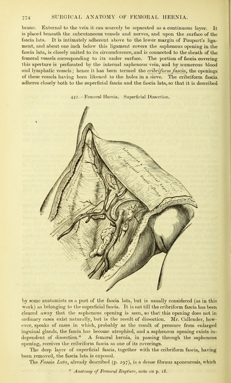 brane. External to the vein it can scarcely be separated as a continuous layer. It is placed beneath the subcutaneous vessels and nerves, and upon the surface of the fascia lata. It is intimately adherent above to the lower margin of Poupart's liga- ment, and about one inch below this ligament covers the saphenous opening in the fascia lata, is closely united to its circumference, and is connected to the sheath of the femoral vessels corresponding to its under surface. The portion of fascia covering this aperture is perforated by the internal saphenous vein, and by numerous blood and lymphatic vessels; hence it has been termed the cribriform fascia, the openings of these vessels having been likened to the holes in a sieve. The cribriform fascia adheres closely both to the superficial fascia and the fascia lata, so that it is described 442.—Femoral Hernia. Superficial Dissection. by some anatomists as a part of the fascia lata, but is usually considered (as in this work) as belonging to the superficial fascia. It is not till the cribriform fascia has been cleared away that the saphenous opening is seen, so that this opening does not in ordinary cases exist naturally, but is the result of dissection. Mr. Callender, how- ever, speaks of cases in which, probably as the result of pressure from enlarged inguinal glands, the fascia has become atrophied, and a saphenous opening exists in- dependent of dissection.* A femoral hernia, in passing through the saphenous opening, receives the cribriform fascia as one of its coverings. The deep layer of superficial fascia, together with the cribriform fascia, having been removed, the fascia lata is exposed. The Fascia Lata, already described (p. 297), is a dense fibrous aponeurosis, which * Anatomy of Femoral Rupture, note on p. 18.