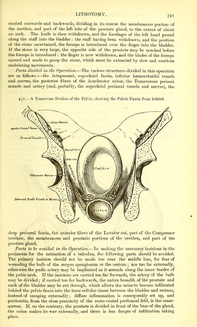 LITHOTOMY. 791 carried outwards and backwards, dividing in its course the membranous portion of the urethra, and part of the left lobe of the prostate gland, to the extent of about an inch. The knife is then withdrawn, and the forefinger of the left hand passed along the staff into the bladder: the staff having been withdrawn, and the position of the stone ascertained, the forceps is introduced over the finger into the bladder. If the stone is very large, the opposite side of the prostate may be notched before the forceps is introduced : the finger is now withdrawn, and the blades of the forceps opened and made to grasp the stone, which must be extracted by slow and cautious undulating movements. Parts divided in tlie Operation.—The various structures divided in this operation are as follows:—the integument, superficial fascia, inferior hsemorrhoidal vessels and nerves, the posterior fibres of the Accelerator urinae, the Transversus perinaii muscle and artery (and, probably, the superficial perinaeal vessels and nerves), the 452.—A Transverse Section of the Pelvis, showing the Pelvic Fascia from behind. deep perinseal fascia, the anterior fibres of the Levator ani, part of the Compressor urethral, the membranous and prostatic portions of the urethra, and part of the prostate gland. Parts to be avoided in the Operation,—In making the necessary incisions in the perinaeum for the extraction of a calculus, the following parts should be avoided. The primary incision should not be made too near the middle line, for fear of wounding the bulb of the corpus spongiosum or the rectum ; aor too far externally, otherwise the pudic artery may be implicated as it ascends along the inner border of the pubic arch. If the incisions are carried too far forwards, the artery of the bulb may be divided; if carried too far backwards, the entire breadth of the prostate and neck of the bladder may be cut through, which allows the urine to become infiltrated behind the pelvic fascia into the loose cellular tissue between the bladder and rectum, instead of escaping externally; diffuse inflammation is consequently set up, and peritonitis, from the close proximity of the recto-vesical peritoneal fold, is the conse- quence. If, on the contrary, the prostate is divided in front of the base of the gland, the m ine makes its wav externally, and there is less danger of infiltration taking place.