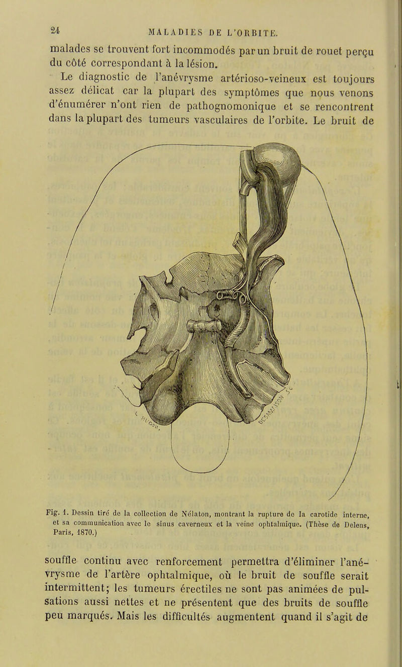 malades se trouvent fort incommodés par un bruit de rouet perçu du côté correspondant à la lésion. Le diagnostic de l'anévrysme artérioso-veineux est toujours assez délicat car la plupart des symptômes que nous venons d'énumérer n'ont rien de pathognomonique et se rencontrent dans la plupart des tumeurs vasculaires de l'orbite. Le bruit de Fig. 1. Dessin tiré de la collection de Nélaton, montrant la rupture de la carotide interne, et sa communication avec le sinus caverneux et la veine ophtalmique. (Thèse de Delens Paris, 1870.) souffle continu avec renforcement permettra d'éliminer l'ané- vrysme de l'artère ophtalmique, où le bruit de souffle serait intermittent; les tumeurs érectiles ne sont pas animées de pul- sations aussi nettes et ne présentent que des bruits de souffle peu marqués. Mais les difficultés augmentent quand il s'agit de