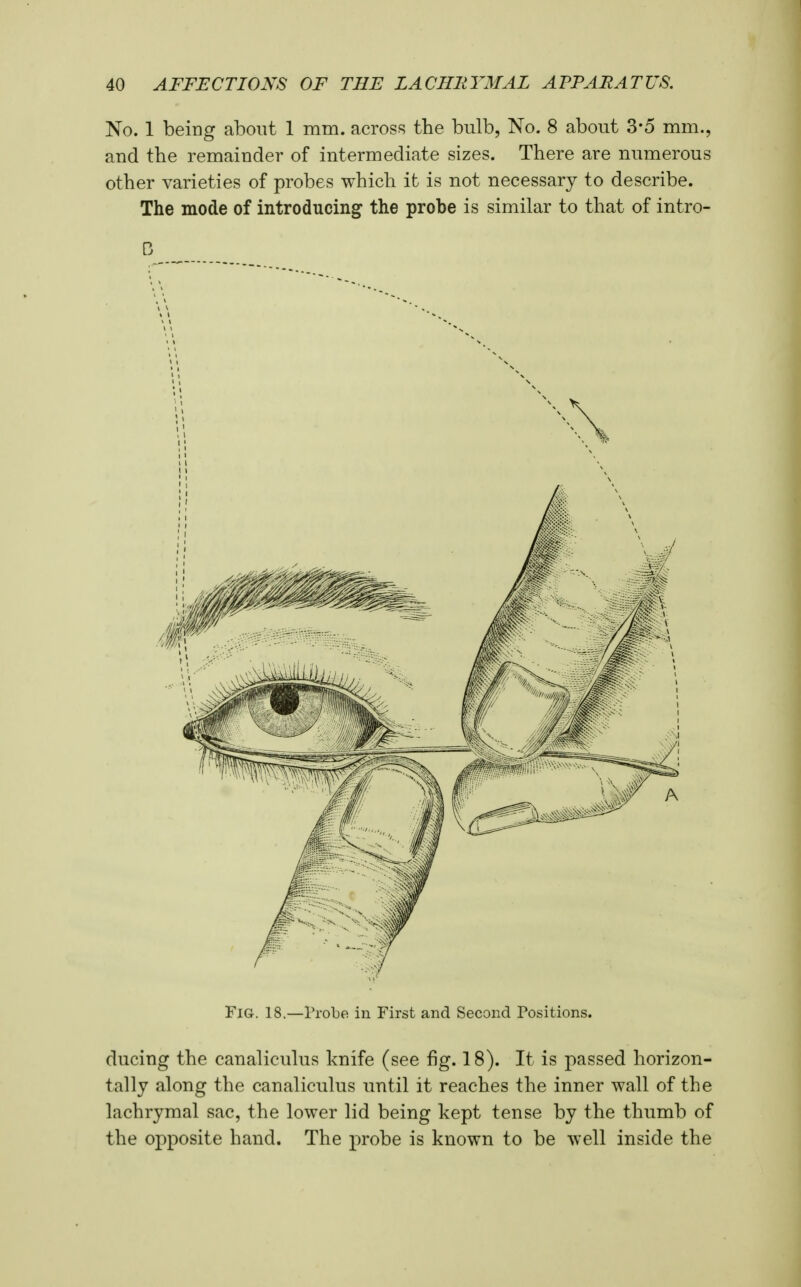 No. 1 being about 1 mm. across the bulb, No. 8 about 3*5 mm., and the remainder of intermediate sizes. There are numerous other varieties of probes which it is not necessary to describe. The mode of introducing the probe is similar to that of intro- Fig. 18.—Probe in First and Second Positions. ducing the canaliculus knife (see fig. 18). It is passed horizon- tally along the canaliculus until it reaches the inner wall of the lachrymal sac, the lower lid being kept tense by the thumb of the opposite hand. The probe is known to be well inside the