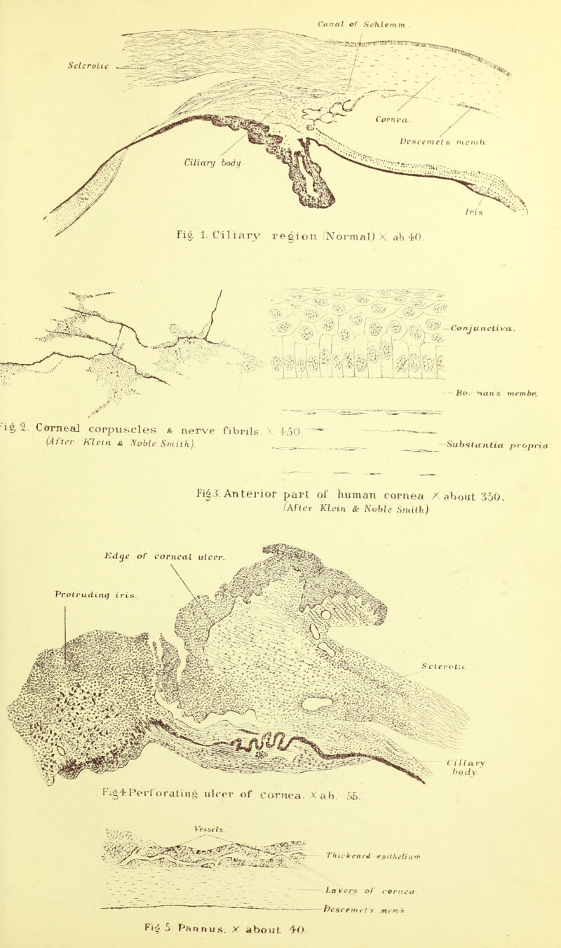 C'annl of JHchlemm ConJunct-ivcL, Bo: -nans membr. 1^. 2. Corrneal corpuscles & nerve fibrils. X i-oO. (After Klein &. A'oble Smith). , -Suhslanliu propria. Fi^.3. Anterior part oi' Kiimaii cornea / ^hout ;^50> ?AHer Klein &• Nohle .Smith) Layers of i-oniL'a Descent ft s ntrmk Fi^ 5 Pan nu&. X about 40