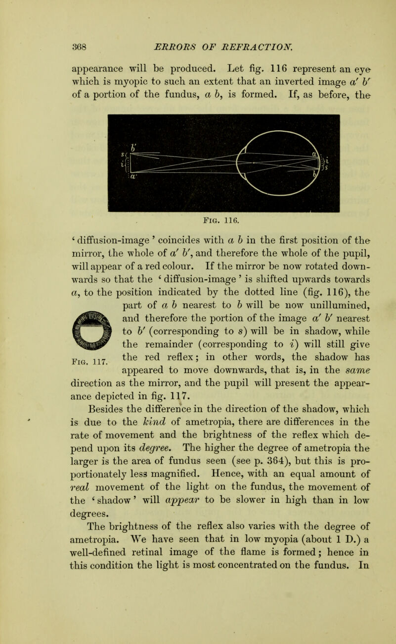 appearance will be produced. Let fig. 116 represent an eye which is myopic to such an extent that an inverted image a' V of a portion of the fundus, a 6, is formed. If, as before, the Fig. 116. ' diffusion-image ' coincides with a 6 in the first position of the mirror, the whole of a' h\ and therefore the whole of the pupil, will appear of a red colour. If the mirror be now rotated down- wards so that the ' diffusion-image ' is shifted upwards towards a, to the position indicated by the dotted line (fig. 116), the part oi ah nearest to h will be now unillumined. and therefore the portion of the image a' V nearest to y (corresponding to s) will be in shadow, while the remainder (corresponding to %) will still give Fig 117 reflex; in other words, the shadow has appeared to move downwards, that is, in the same direction as the mirror, and the pupil will present the appear- ance depicted in fig. 117. Besides the difference in the direction of the shadow, which is due to the kind of ametropia, there are differences in the rate of movement and the brightness of the reflex which de- pend upon its degree. The higher the degree of ametropia the larger is the area of fundus seen (see p. 364), but this is pro- portionately less magnified. Hence, with an equal amount of real movement of the light on the fundus, the movement of the ' shadow' will appear to be slower in high than in low degrees. The brightness of the reflex also varies with the degree of ametropia. We have seen that in low myopia (about 1 D.) a well-defined retinal image of the flame is formed; hence in this condition the light is most concentrated on the fundus. In