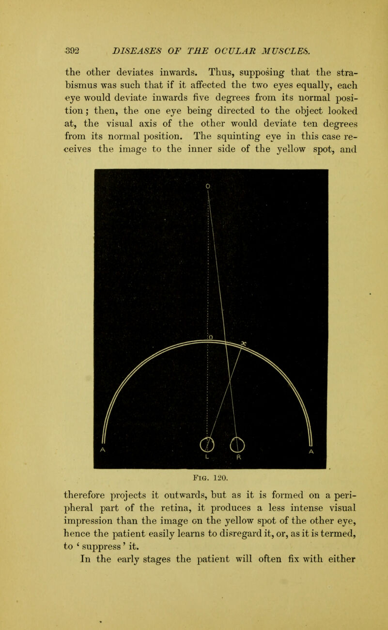 the other deviates inwards. Thus, supposing that the stra- bismus was such that if it affected the two eyes equally, each €ye would deviate inwards five degrees from its normal posi- tion ; then, the one eye being directed to the object looked at, the visual axis of the other would deviate ten degrees from its normal position. The squinting eye in this case re- ceives the image to the inner side of the yellow spot, and Fig. 120. therefore projects it outwards, but as it is formed on a peri- pheral part of the retina, it produces a less intense visual impression than the image on the yellow spot of the other eye, hence the patient easily learns to disregard it, or, as it is termed, to ' suppress' it. In the early stages the patient will often fix with either