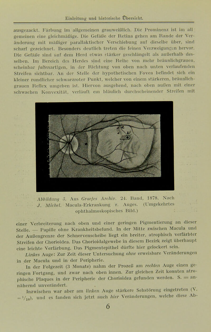 ausgezackt. Färbung im allgemeinen grauweißlich. Die Prominenz ist im all gemeinen eine gleichmäßige. Die Gefäße der Retina geben am Rande der Vit änderüng mit mäßiger parallaktischer Verschiebung au! dieselbe über, sind scharf gezeichnet. Besonders deutlich treten die feinen Verzweigungen hervor. Die Gefäße sind auf dem Heid etwas stärker geschlängelt als außerhalb des- selben. Im Bereich des Herdes sind eine Reihe von mehr bräunlichgrauen, scheinbar /«//('/(artigen, in der Richtung von oben nach unten verlaufenden Streifen sichtbar. An der Stelle der hypothetischen Fovea befindet sich ein kleiner rundlicher schwarzroter Punkt, welcher von einem stärkeren, bräunlich grauen Reflex umgeben ist. Hiervon ausgehend, nach oben außen mit einer schwachen Konvexität, verläuft ein bläulich durchscheinender Streifen mit V * W 1 i - M W Abbildung 3. Aus Grae/es Archiv. 24. Band, 1878. Nach J. Michel. Macula-Erkrankung r. Auges. (Umgekehrtes ophthalmoskopisches Bild.) einer Verbreiterung nach oben und einer geringen Pigmentierung an dieser Stelle. — Papille ohne Krankheitsbefund. In der Mitte zwischen Macula und der Außengrenze der Sehnervenscheibe liegt ein breiter, atrophisch verfärbter Streifen der Chorioidea. Das Chorioidalgewebe in diesem Bezirk zeigt überhaupf eine leichte Verfärbung. Das Pigmentepithel dürfte hier gelockert sein. Linkes Auge: Zur Zeit dieser Untersuchung ohne erweisbare Veränderungen in der Macula und in der Peripherie. In der Folgezeit (3 Monate) nahm der Prozeß am rechten Auge einen ge ringen Fortgang, und zwar nach oben innen. Zur gleichen Zeit konnten atro- phische Plaques in der Peripherie der Chorioidea gefunden werden. S. = an- nähernd unverändert. Inzwischen war aber am Unken Auge stärkere Sehslörung eingetreten (V. = '/io)> und es fanden sich jetzt auch hier Veränderungen, welche diese Ab-