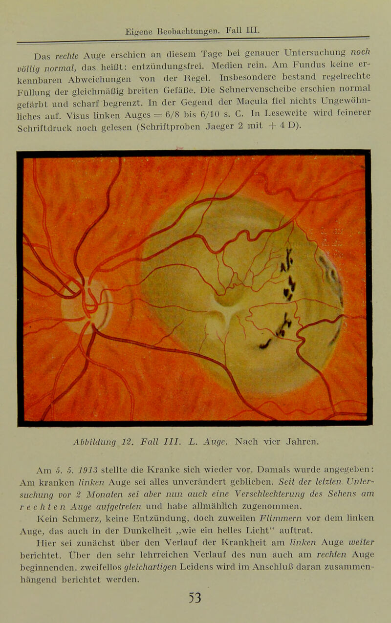 Das rechte Auge erschien an diesem Tage bei genauer Untersuchung noch völlig normal, das heißt: entzündungsfrei. Medien rein. Am Fundus keine er- kennbaren Abweichungen von der Regel. Insbesondere bestand regelrechte FüUung der gleichmäßig breiten Gefäße. Die Sehnervenscheibe erschien normal gefärbt und scharf begrenzt. In der Gegend der Macula fiel nichts Ungewöhn- liches auf. Visus linken Auges = 6/8 bis 6/10 s. C. In Leseweite wird feinerer Schriftdruck noch gelesen (Schriftproben Jaeger 2 mit + 4 D). Abbildung 12. Fall III. L. Auge. Nach vier Jahren. Am 5. 5. 1913 stellte die Kranke sich wieder vor. Damals wurde angegeben: Am kranken linken Auge sei alles unverändert geblieben. Seit der letzten Unter- suchung vor 2 Monaten sei aber nun auch eine Verschlechterung des Sehens am rechten Auge aufgetreten und habe allmählich zugenommen. Kein Schmerz, keine Entzündung, doch zuweilen Flimmern vor dem linken Auge, das auch in der Dunkelheit „wie ein helles Licht auftrat. Hier sei zunächst über den Verlauf der Krankheit am linken Auge weiter berichtet. I ber den sehr lehrreichen Verlauf des nun auch am rechten Auge beginnenden, zweifellos gleichartigen Leidens wird im Anschluß daran zusammen- hängend berichtet werden.