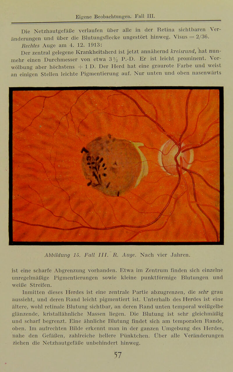 Die Netzhautgefäße verlaufen über alle in der Retina siebtbaren Ver- änderungen und über die Blutungsflecke ungestört hinweg. Visus = 2/36. Rechtes Auge am 4. 12. 1913: Der zentral gelegene Krankheitsherd ist jetzt annähernd kreisrund, hat nun- mehr einen Durchmesser von etwa 3% P.-D. Er ist leicht prominent. Vor- wölbung aber höchstens +1D. Der Herd hat eine graurote Farbe und weist an einigen Stellen leichte Pigmentierung auf. Nur unten und oben nasenwärts 1  Abbildung 15. Fall III. R. Auge. Nach vier Jahren. ist eine scharfe Abgrenzung vorhanden. Etwa im Zentrum finden sich einzelne unregelmäßige Pigmentierungen sowie kleine punktförmige Blutungen und weiße Streifen. Inmitten dieses Flercles ist eine zentrale Partie abzugrenzen, die sehr grau aussieht, und deren Rand leicht pigmentiert ist. Unterhalb des Herdes ist eine ältere, wohl retinale Blutung sichtbar, an deren Rand unten temporal weißgelbe glänzende, kristallähnliche Massen liegen. Die Blutung ist sehr gleichmäßig und scharf begrenzt. Eine ähnliche Blutung findet sich am temporalen Rande, oben. Im aufrechten Bilde erkennt man in der ganzen Umgebung des Herdes, nahe den Gefäßen, zahlreiche hellere Pünktchen. Über alle Veränderungen ziehen die Netzhautgefäße unbehindert hinweg.