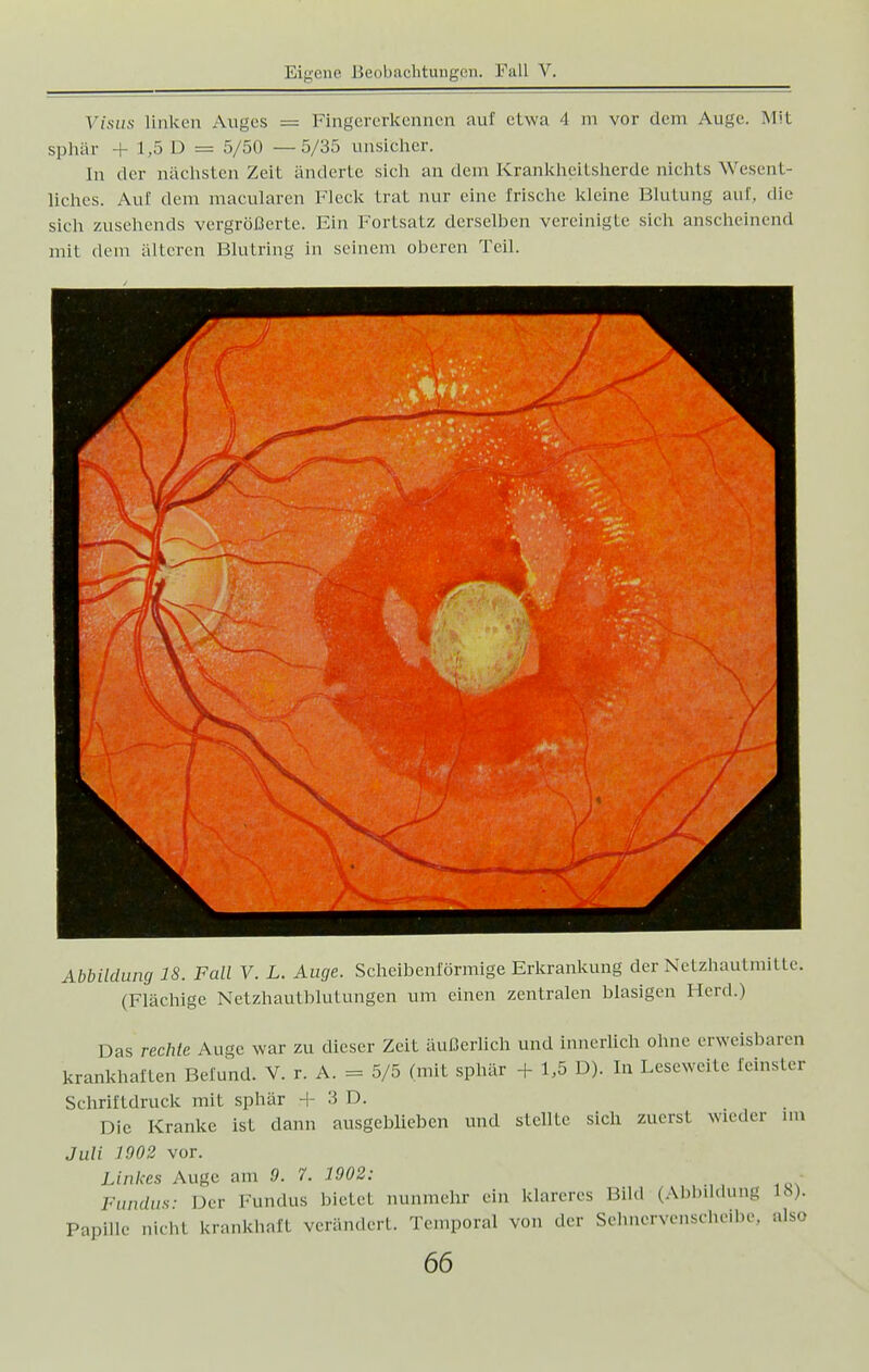 Visus linken Auges = Fingererkennen auf etwa 4 m vor dem Auge. Mit sphär + 1,5 D = 5/50 —5/35 unsicher. In der nächsten Zeit änderte sich an dem Krankheitsherde nichts Wesent- liches. Auf dem macularen Fleck trat nur eine Irische kleine Blutung auf, die sieh zusehends vergrößerte. Ein Fortsatz derselben vereinigte sich anscheinend mit dein älteren Blutring in seinem oberen Teil. Abbildung IS. Fall V. L. Auge. Scheibenförmige Erkrankung der Netzhautmitte. (Flächige Netzhautblutungen um einen zentralen blasigen Herd.) Das rechte Auge war zu dieser Zeit äußerlich und innerlich ohne erweisbaren krankhaften Befund. V. r. A. = 5/5 (mit sphär + 1,5 D). In Lesewcitc feinster Schriftdruck mit sphär + 3 D. Die Kranke ist dann ausgeblieben und stellte sich zuerst wieder im Juli 1002 vor. Linkes Auge am 0. 7. 1002: Fundus- Der Fundus bietet nunmehr ein klareres Bild (Abbildung 18). Papille nicht krankhaft verändert. Temporal von der Sehnervenscheibe, also