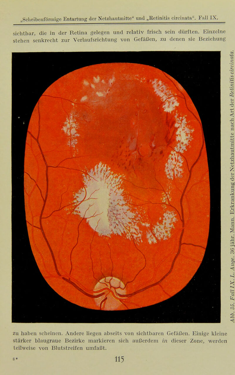 sichtbar, die in der Retina gelegen und relativ frisch sein dürften. Einzelne stehen senkrecht zur Verlaufsrichtung von Gefäßen, zu denen sie Beziehung zu haben scheinen. Andere liegen abseits von sichtbaren Gefäßen. Einige kleine stärker blaugraue Bezirke markieren sich außerdem in dieser Zone, werden teilweise von Blutstreifen umfaßt.