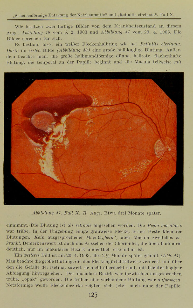 Wir besitzen zwei farbige Bilder von dem Krankheitszustand an diesem Auge, Abbildung 40 vom 5. 2. 1903 und Abbildung 41 vom 29. 4. 1903. Die Bilder sprechen für sich. Es bestand also: ein weißer Fleckenhalbring wie bei Retinitis circinata. Darin im ersten Bilde (Abbildung 40) eine große halbkuglige Blutung. Außer- dem beachte man: die große halbmondförmige dünne, hellrote, flächenhafte Blutung, die temporal an der Papille beginnt und die Macula teilweise mit Abbildung 41. Fall X. R. Auge. Etwa drei Monate später. einnimmt. Die Blutung ist als retinale angesehen worden. Die Regio macularis war trübe. In der Umgebung einige grauweise Flecke, ferner Reste kleinerer Blutungen. Kein ausgesprochener Macula,,herd, aber Macula zweifellos er- krankt. Bemerkenswert ist auch das Aussehen der Chorioidea, die überall abnorm deutlich, nur im makularen Bezirk undeutlich erkennbar ist. Ein weiteres Bild ist am 20. 4. 1903, also 2% Monate später gemalt (Abb. 41). Man beachte die große Blutung, die den Fleckengürtel teilweise verdeckt und über den die Gefäße der Retina, soweit sie nicht überdeckt sind, mit leichter bogiger Abbiegung hinwegzichen. Der maculare Bezirk war inzwischen ausgesprochen trübe, „opak geworden. Die früher hier vorhandene Blutung war ausgesogen. Netzförmige weiße Fleckenbczirke zeigten sich jetzt auch nahe der Papille.