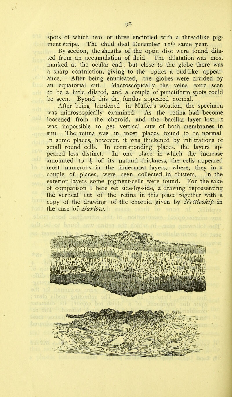 spots of which two or three encircled with a threadlike pig- ment stripe. The child died December 11th same year. By section, the sheaths of the optic disc were found dila- ted from an accumulation of fluid. The dilatation was most marked at the ocular end; but close to the globe there was a sharp contraction, giving to the optics a bud-like appear- ance. After being enucleated, the globes were divided by an equatorial cut. Macroscopically the veins were seen to be a little dilated, and a couple of punctiform spots could be seen. Byond this the fundus appeared normal. After being hardened in Miiller's solution, the specimen was microscopically examined. As the retina had become loosened from the choroid, and the bacillar layer lost, it was impossible to get vertical cuts of both membranes in situ. The retina was in most places found to be normal. In some places, however, it was thickened by infiltrations of small round cells. In corresponding places, the layers ap- peared less distinct. In one place, in which the increase amounted to J of its natural thickness, the cells appeared most numerous in the innermost layers, where, they in a couple of places, were seen collected in clusters. In the exterior layers some pigment-cells were found. For the sake of comparison I here set side-by-side, a drawing representing the vertical cut of the retina in this place together with a copy of the drawing of the choroid given by Nettleship in the case of Barlow.
