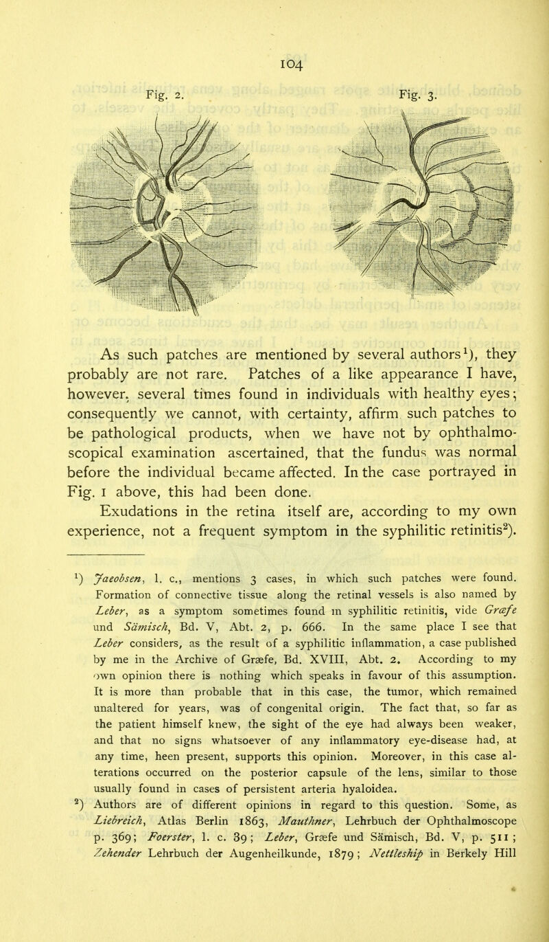 Fig. 2. Fig. 3. As such patches are mentioned by several authors1), they probably are not rare. Patches of a like appearance I have, however, several times found in individuals with healthy eyes; consequently we cannot, with certainty, affirm such patches to be pathological products, when we have not by ophthalmo- scopical examination ascertained, that the fundus was normal before the individual became affected. In the case portrayed in Fig. 1 above, this had been done. Exudations in the retina itself are, according to my own experience, not a frequent symptom in the syphilitic retinitis2). *) Jaeobsen, 1. c, mentions 3 cases, in which such patches were found. Formation of connective tissue along the retinal vessels is also named by Leber, as a symptom sometimes found m syphilitic retinitis, vide Grafe und Samisch, Bd. V, Abt. 2, p. 666. In the same place I see that Leber considers, as the result of a syphilitic inflammation, a case published by me in the Archive of Grsefe, Bd. XVIII, Abt. 2. According to my own opinion there is nothing which speaks in favour of this assumption. It is more than probable that in this case, the tumor, which remained unaltered for years, was of congenital origin. The fact that, so far as the patient himself knew, the sight of the eye had always been weaker, and that no signs whatsoever of any inilammatory eye-disease had, at any time, heen present, supports this opinion. Moreover, in this case al- terations occurred on the posterior capsule of the lens, similar to those usually found in cases of persistent arteria hyaloidea. 2) Authors are of different opinions in regard to this question. Some, as Liebreich, Atlas Berlin 1863, Mauthner, Lehrbuch der Ophthalmoscope p. 369; Foerster, 1. c. 39; Leber, Graefe und Samisch, Bd. V, p. 511; Zehender Lehrbuch der Augenheilkunde, 1879 > Nettleship in Berkely Hill
