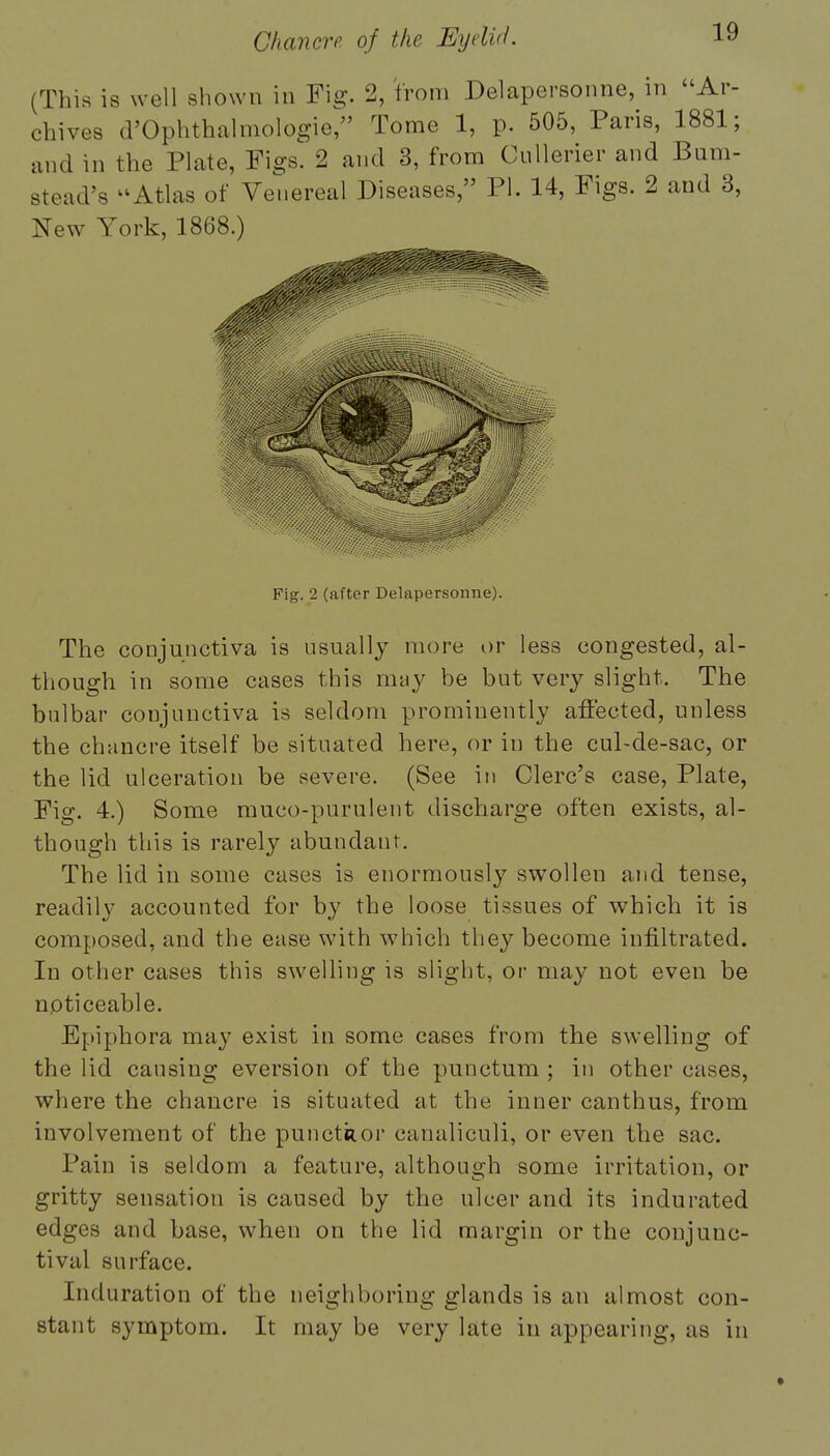 (This is well shown in Fig. 2, from Delapersonne, in Ar- chives d'Ophthalmologie, Tome 1, p. 505, Paris, 1881; and m the Plate, Figs. 2 and 3, from Cullerier and Bum- stead's -Atlas of Venereal Diseases, PI. 14, Figs. 2 and 3, New York, 1868.) Fig. 2 (after Delapersonne). The conjunctiva is usually more or less congested, al- though in some cases this may be but very slight. The bulbar conjunctiva is seldom prominently affected, unless the chancre itself be situated here, or in the cul-de-sac, or the lid ulceration be severe. (See in Clerc's case, Plate, Fig. 4.) Some muco-purulent discharge often exists, al- though this is rarely abundant. The lid in some cases is enormously swollen and tense, readily accounted for by the loose tissues of which it is composed, and the ease with which they become infiltrated. In other cases this swelling is slight, or may not even be npticeable. Epiphora may exist in some cases from the swelling of the lid causing eversion of the punctum ; in other cases, where the chancre is situated at the inner canthus, from involvement of the punctiior canaliculi, or even the sac. Pain is seldom a feature, although some irritation, or gritty sensation is caused by the ulcer and its indurated edges and base, when on the lid margin or the conjunc- tival surface. Induration of the neighboring glands is an almost con- stant symptom. It may be very late in appearing, as in