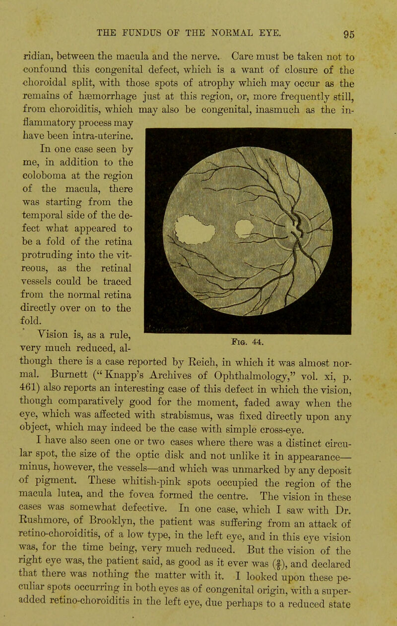 ridian, between the macula and the nerve. Care must be taken not to confound this congenital defect, which is a want of closure of the choroidal split, with those spots of atrophy which may occur as the remains of haemorrhage just at this region, or, more frequently still, from choroiditis, which may also be congenital, inasmuch as the in- flammatory process may have been intra-uterine. In one case seen by me, in addition to the coloboma at the region of the macula, there was starting from the temporal side of the de- fect what appeared to be a fold of the retina protruding into the vit- reous, as the retinal vessels could be traced from the normal retina directly over on to the fold. Vision is, as a rule, very much reduced, al- though there is a case reported by Eeich, in which it was almost nor- mal. Burnett (Knapp's Archives of Ophthalmology, vol. xi, p. 461) also reports an interesting case of this defect in which the vision, though comparatively good for the moment, faded away when the eye, which was affected with strabismus, was fixed directly upon any object, which may indeed be the case with simple cross-eye. I have also seen one or two cases where there was a distinct circu- lar spot, the size of the optic disk and not unlike it in appearance- minus, however, the vessels—and which was unmarked by any deposit of pigment. These whitish-pink spots occupied the region of the macula lutea, and the fovea formed the centre. The vision in these cases was somewhat defective. In one case, which I saw with Dr. Kushmore, of Brooklyn, the patient was suffering from an attack of retino-choroiditis, of a low type, in the left eye, and in this eye vision was, for the time being, very much reduced. But the vision of the right eye was, the patient said, as good as it ever was (£), and declared that there was nothing the matter with it. I looked upon these pe- culiar spots occurring in both eyes as of congenital origin, with a super- added retino-choroiditis in the left eye, due perhaps to a reduced state