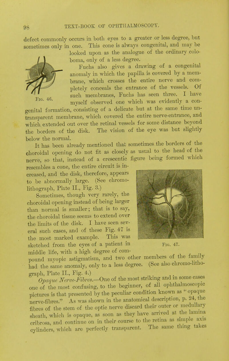 Fig. 46. defect commonly occurs in both eyes to a greater or less degree, but sometimes only in one. This cone is always congenital, and may be looked upon as the analogue of the ordinary colo- boma, only of a less degree. Fuchs also gives a drawing of a congenital anomaly in which the papilla is covered by a mem- brane, which crosses the entire nerve and com- pletely conceals the entrance of the vessels. Of such membranes, Fuchs has seen three. I have myself observed one which was evidently a con- genital formation, consisting of a delicate but at the same time un- transparent membrane, which covered the entire nerve-entrance, and which extended out over the retinal vessels for some distance beyond the borders of the disk. The vision of the eye was but slightly below the normal. It has been already mentioned that sometimes the borders of the choroidal opening do not fit as closely as usual to the head of the nerve, so that, instead of a crescentic figure being formed which resembles a cone, the entire circuit is in- creased, and the disk, therefore, appears to be abnormally large. (See chromo- lithograph, Plate II., Fig. 3.) Sometimes, though very rarely, the choroidal opening instead of being larger than normal is smaller; that is to say, the choroidal tissue seems to extend over the limits of the disk. I have seen sev- eral such cases, and of these Fig. 47 is the most marked example. This was sketched from the eyes of a patient in middle fife, with a high degree of com- pound myopic astigmatism, and two other members of the family had the same anomaly, only to a less degree. (See also chromo-htho- graph, Plate II., Fig. 4-.) Opaque Nerve-Fibres.—One of the most striking and m some cases one of the most confusing, to the beginner, of all ophthalmoscopic pictures is that presented by the peculiar condition known as  opaque nerve-fibres. As was shown in the anatomical description, p. 24, the fibres of the stem of the optic nerve discard their outer or medullary sheath, which is opaque, as soon as they have arrived at the lamina cribrosa, and continue on in their course to the retina as simple axis cylinders, which are perfectly transparent. The same thing takes Fir.. 47.